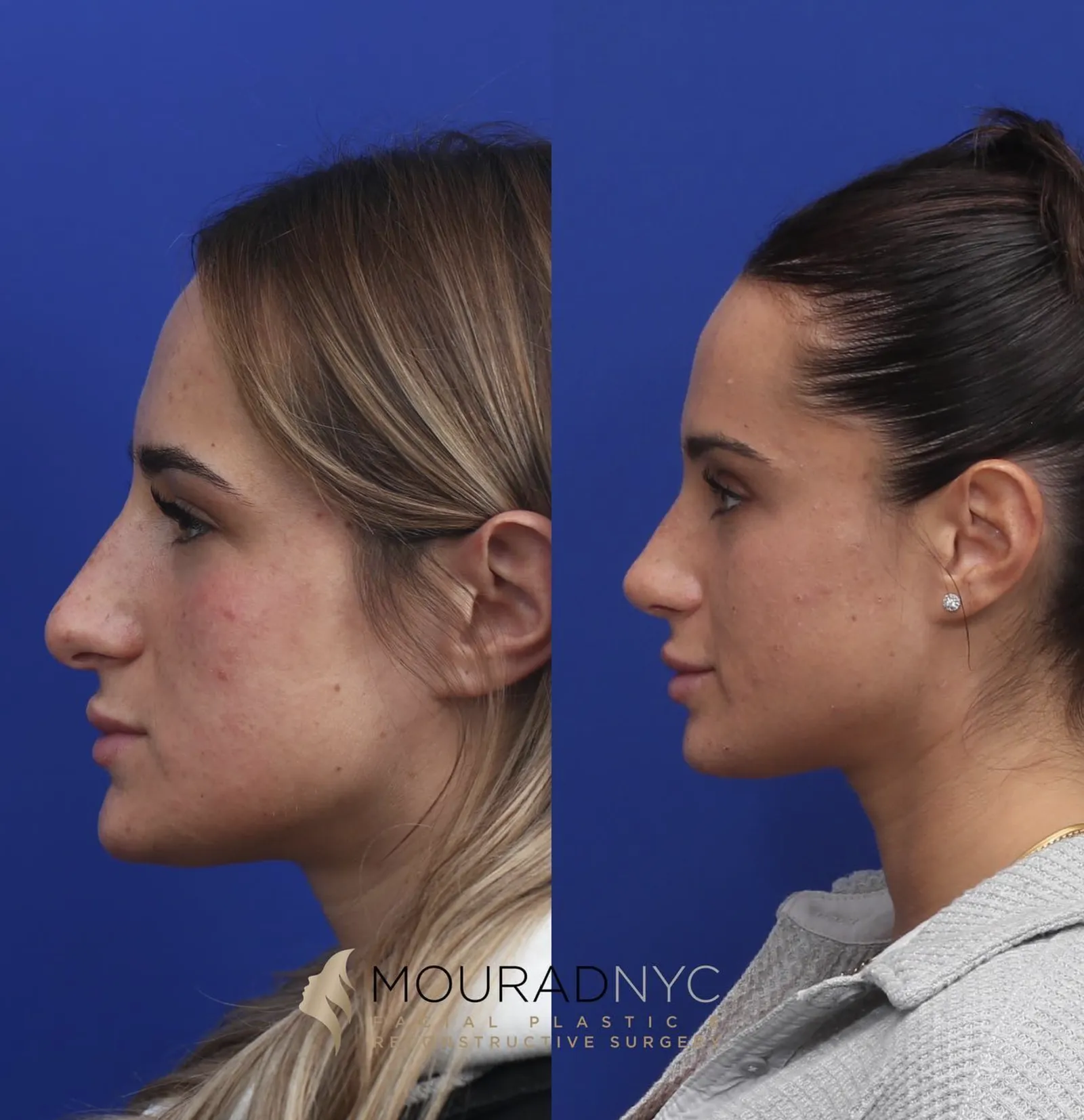 Right lateral profile comparison of a female patient in her 20s before and after primary rhinoplasty