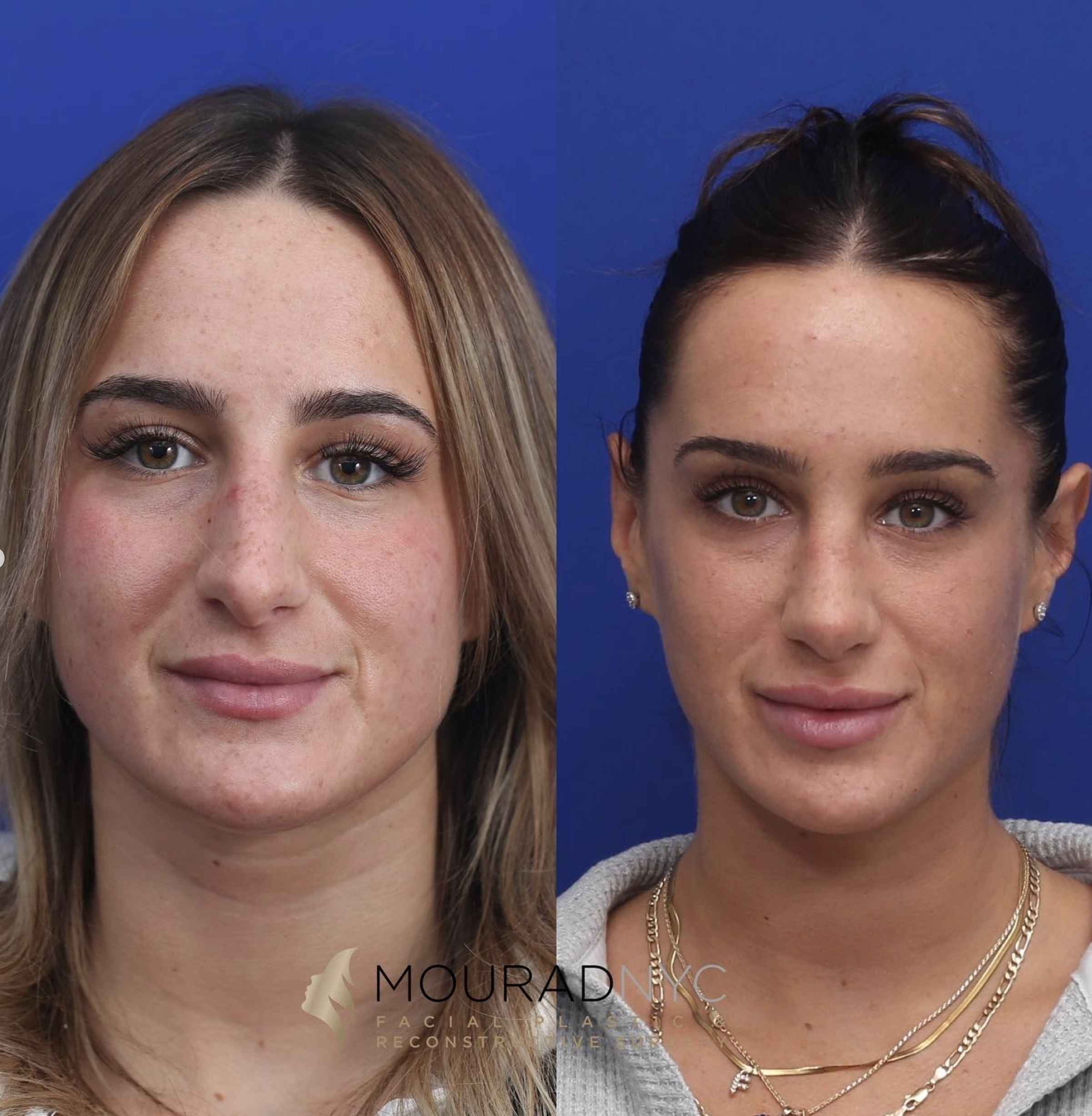 Frontal comparison of a female patient in her 20s before and after primary rhinoplasty