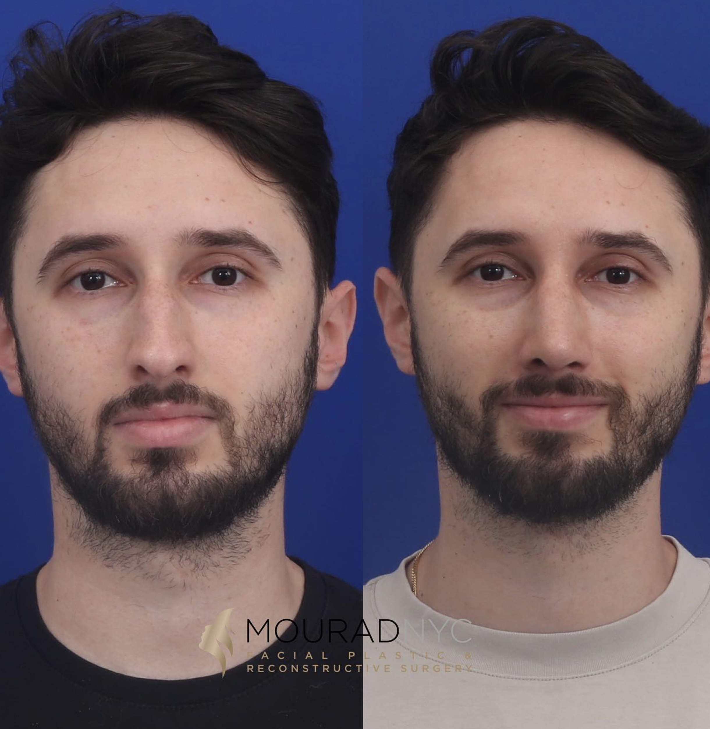 Frontal comparison before and after male primary rhinoplasty