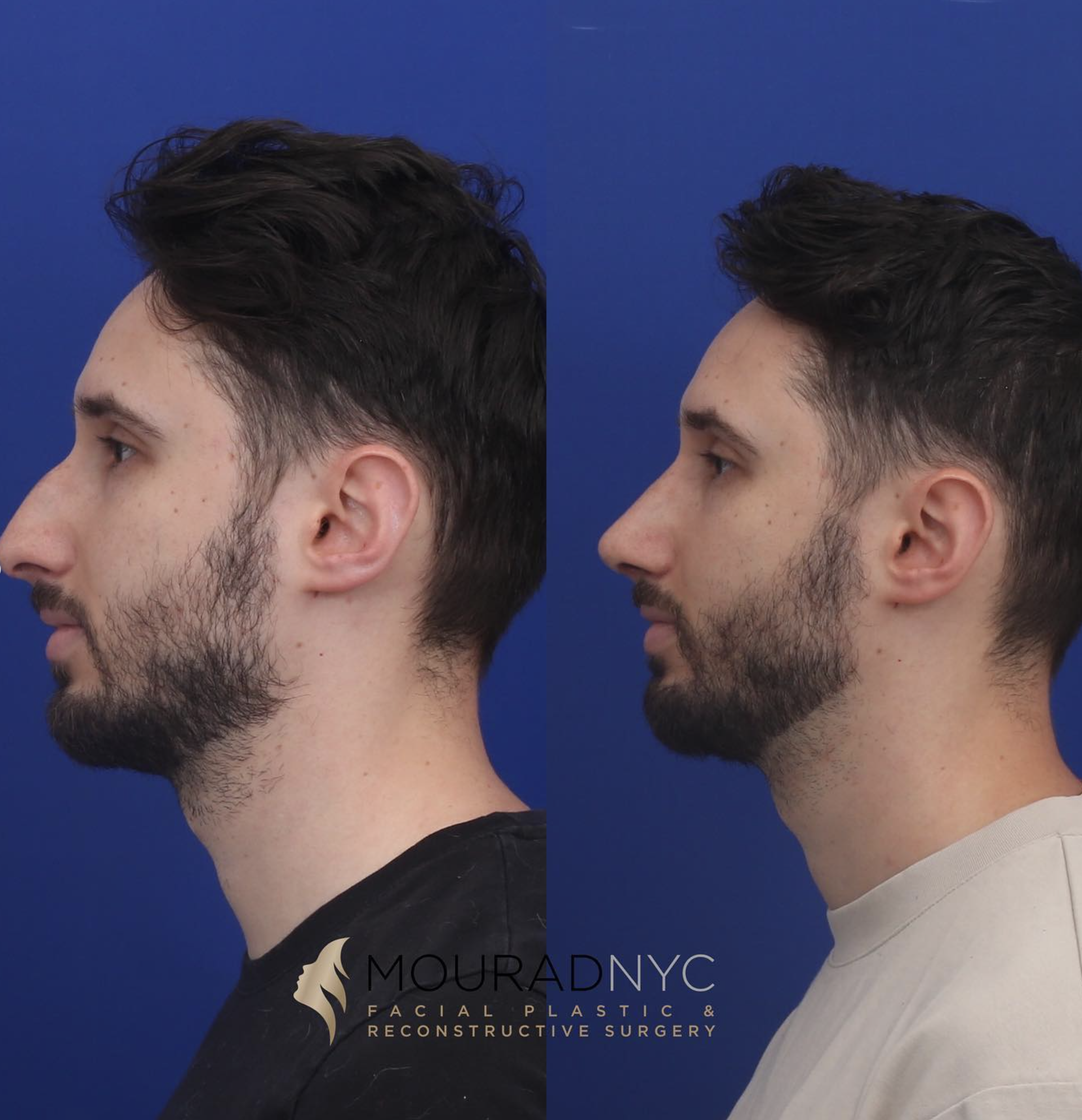 Right lateral profile comparison before and after male primary rhinoplasty