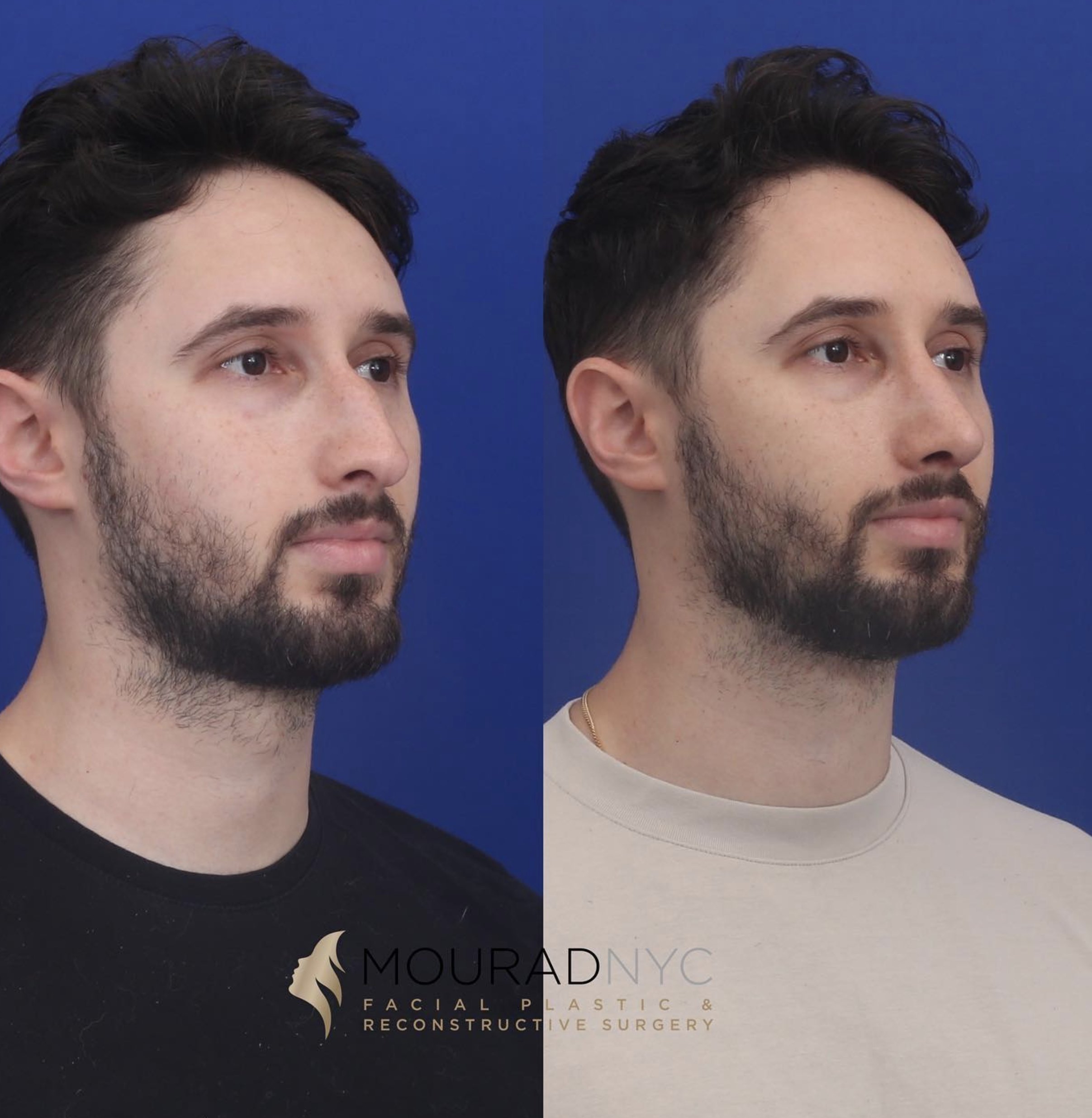 Left oblique comparison before and after male primary rhinoplasty