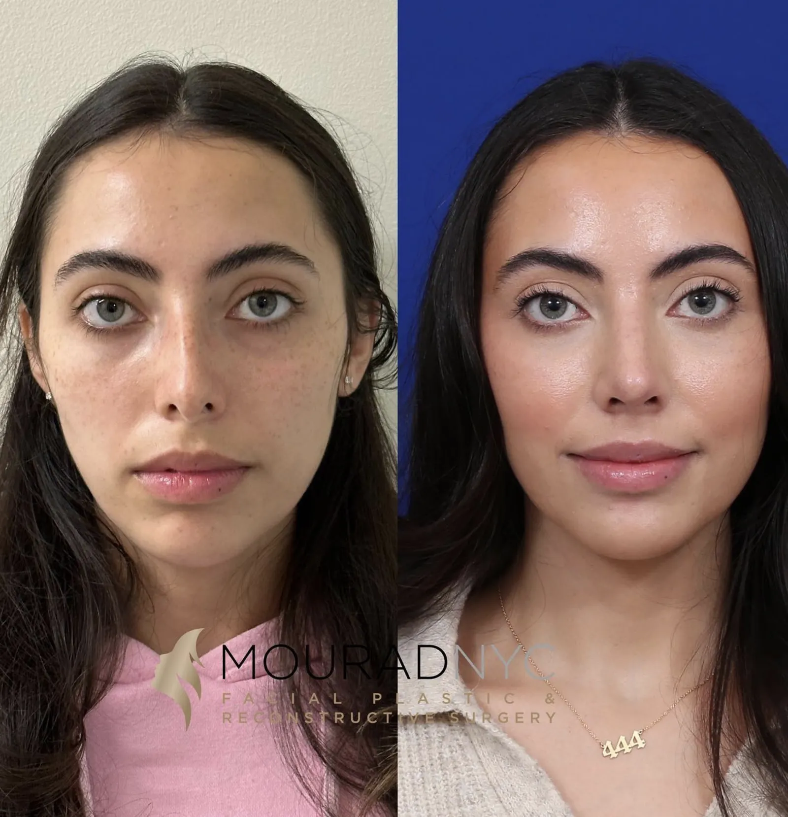 Frontal comparison of a female patient in her 20s before and after primary rhinoplasty