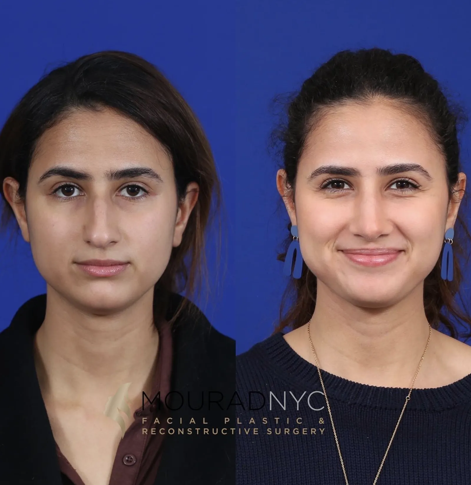 Frontal comparison of a female patient in her 20s before and after primary rhinoplasty