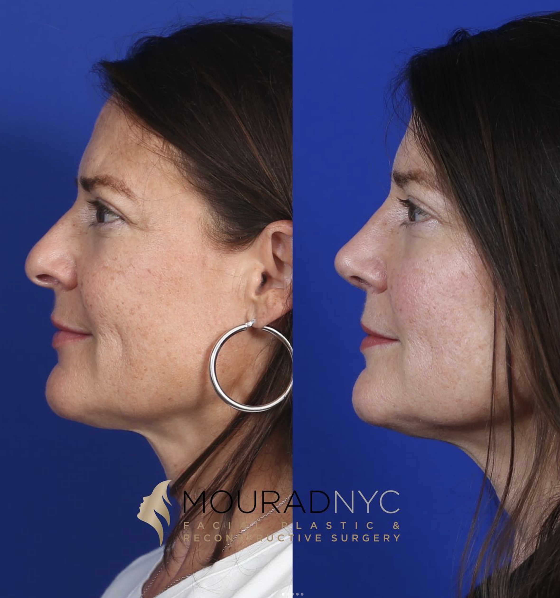 Right lateral profile comparison before and after primary rhinoplasty