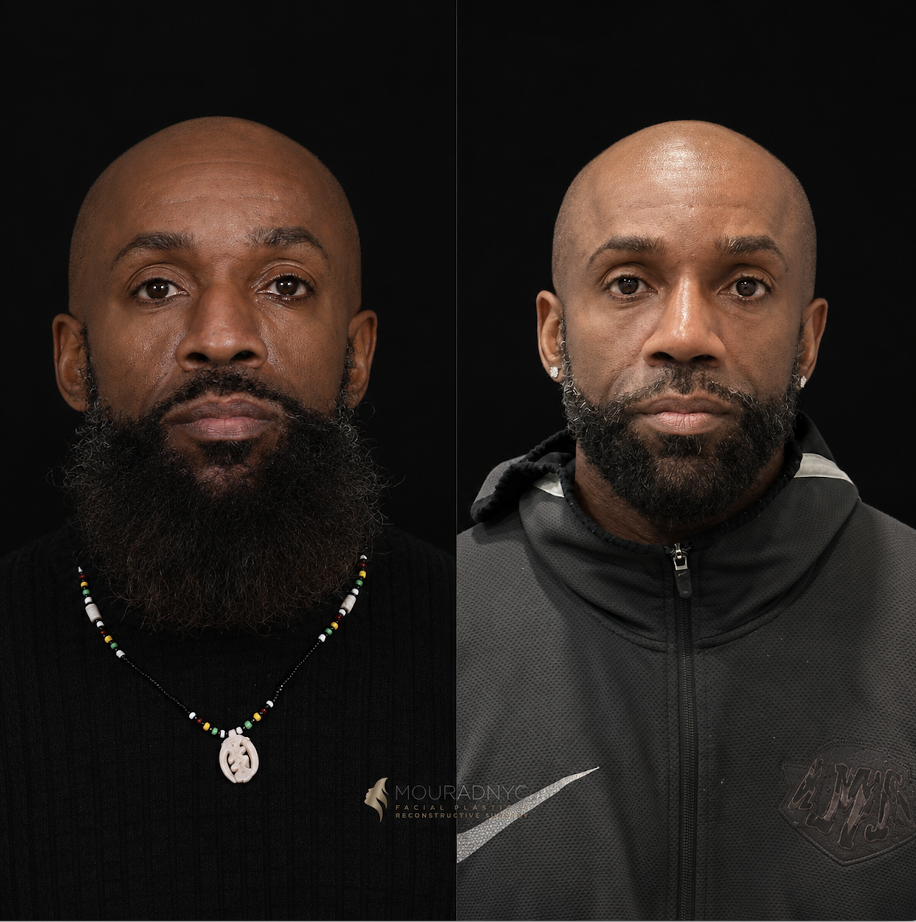 Frontal comparison of a male patient in his 40s before and after ethnic rhinoplasty