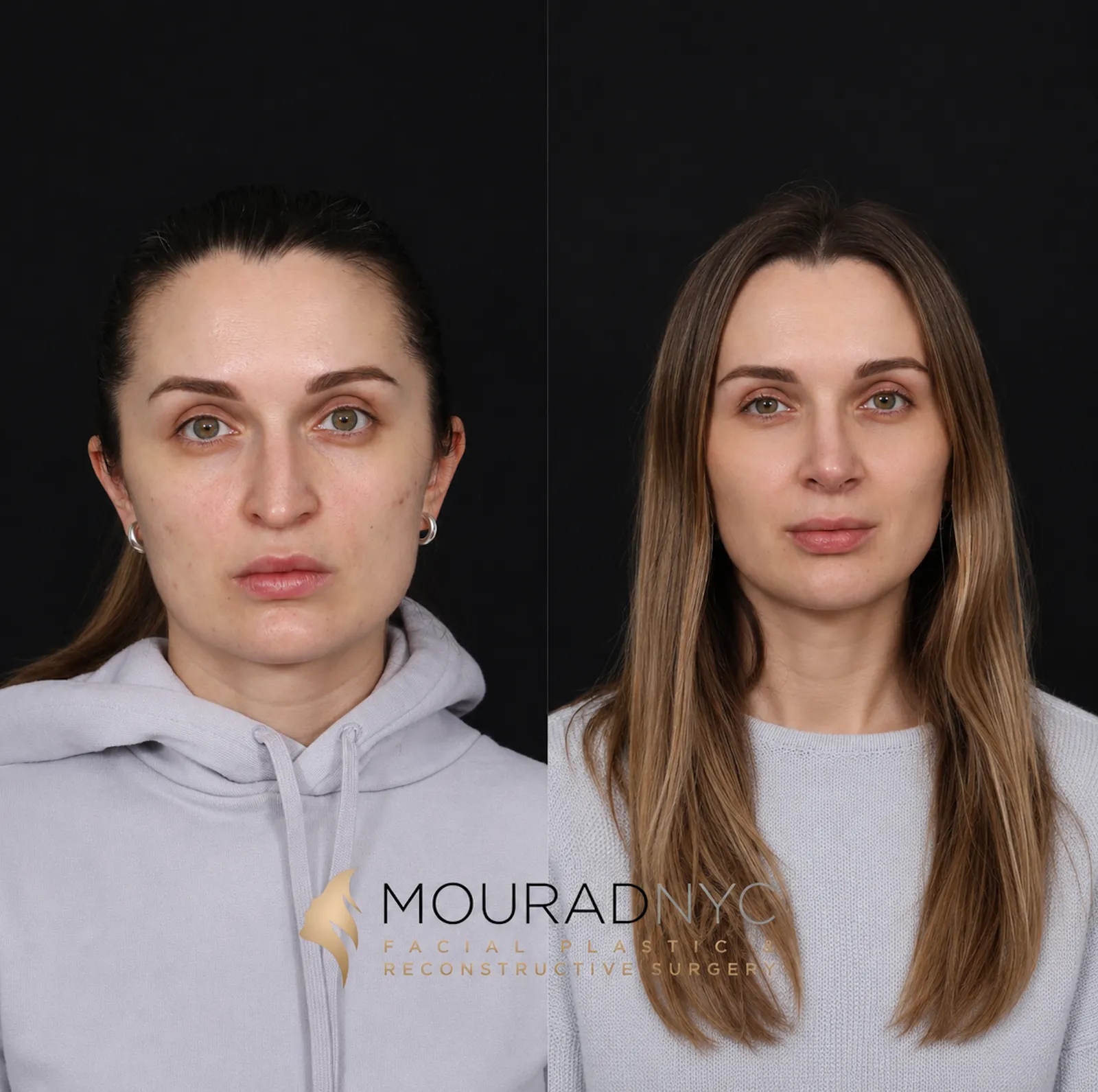 Frontal comparison of a female patient in her 30s before and after revision rhinoplasty