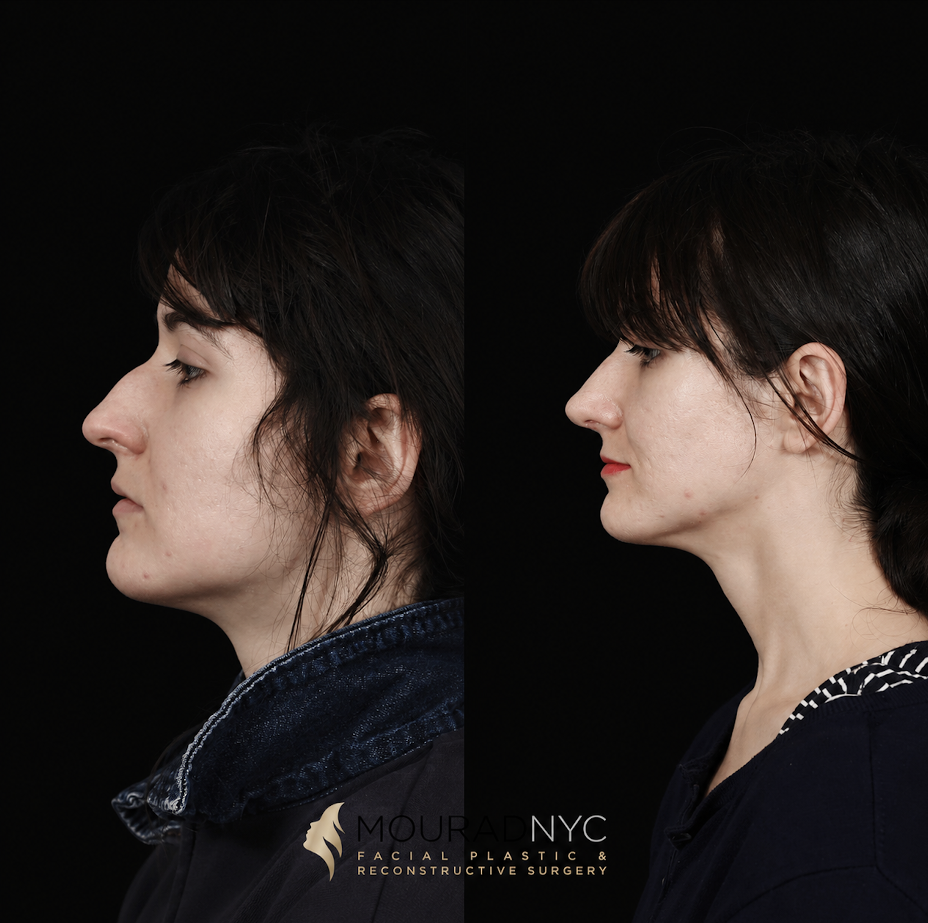 Left lateral profile comparison of a female patient in her 30s before and after broken nose (nasal fracture) repair