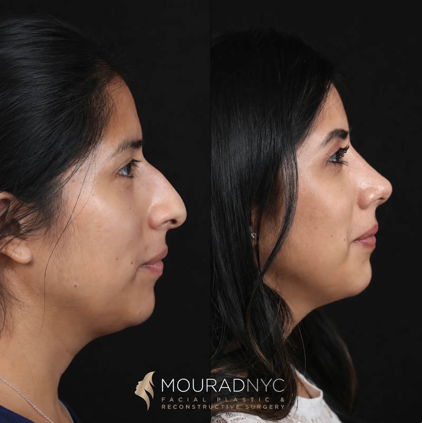 Right lateral profile comparison of female patient in her 30s before and after primary rhinoplasty