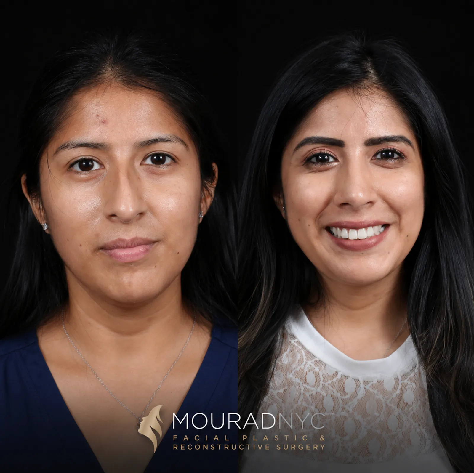 Frontal comparison of female patient in her 30s before and after primary rhinoplasty