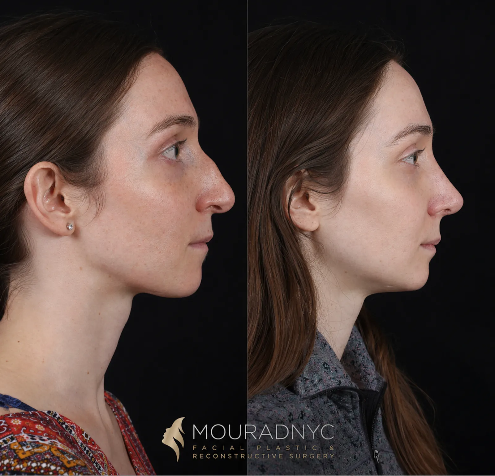 Right lateral profile comparison of a female patient in her 20s before and after primary rhinoplasty that also addressed a nasal fracture