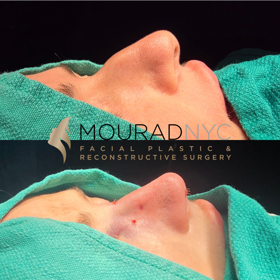 Intra-operative basal view comparison of a female patient in her 50s immediately before and after preservation rhinoplasty