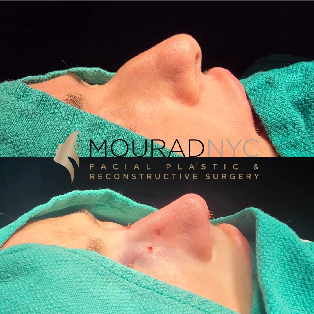 Intra-operative basal view of a female patient in her 50s during preservation rhinoplasty; surgical drapes and sutures are visible