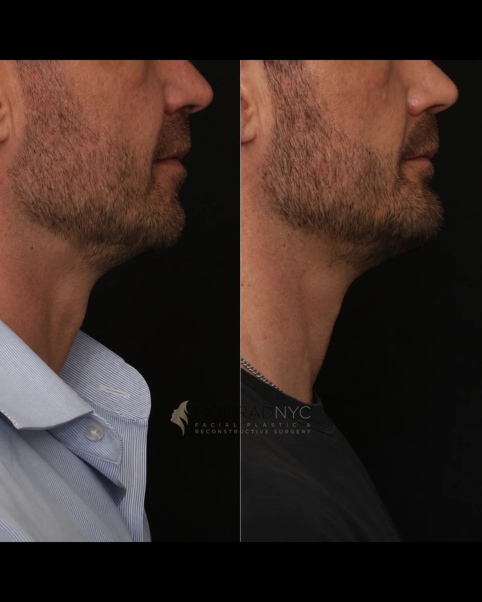 Right lateral profile comparison of a male patient in his 30s before and after chin implant placement