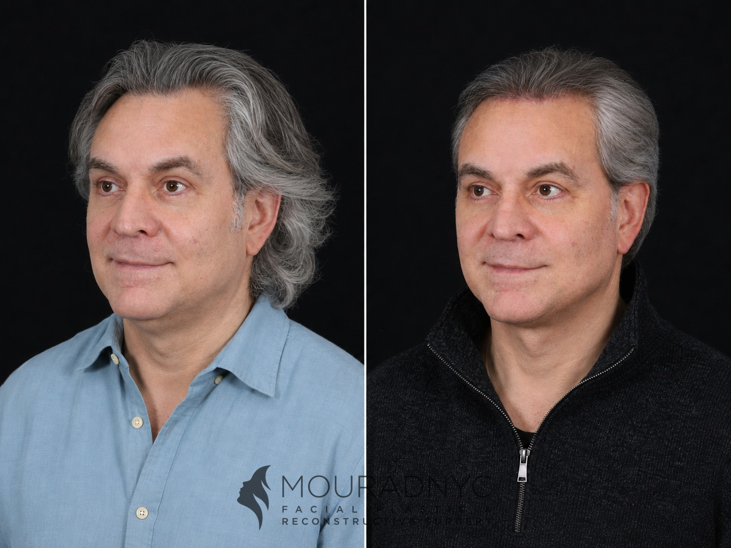 Left oblique comparison of a male patient in his 60s before and after facelift with neck lift