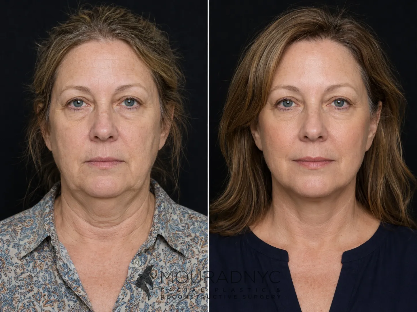 Frontal comparison of a female patient in her 50s before and after facelift with neck lift