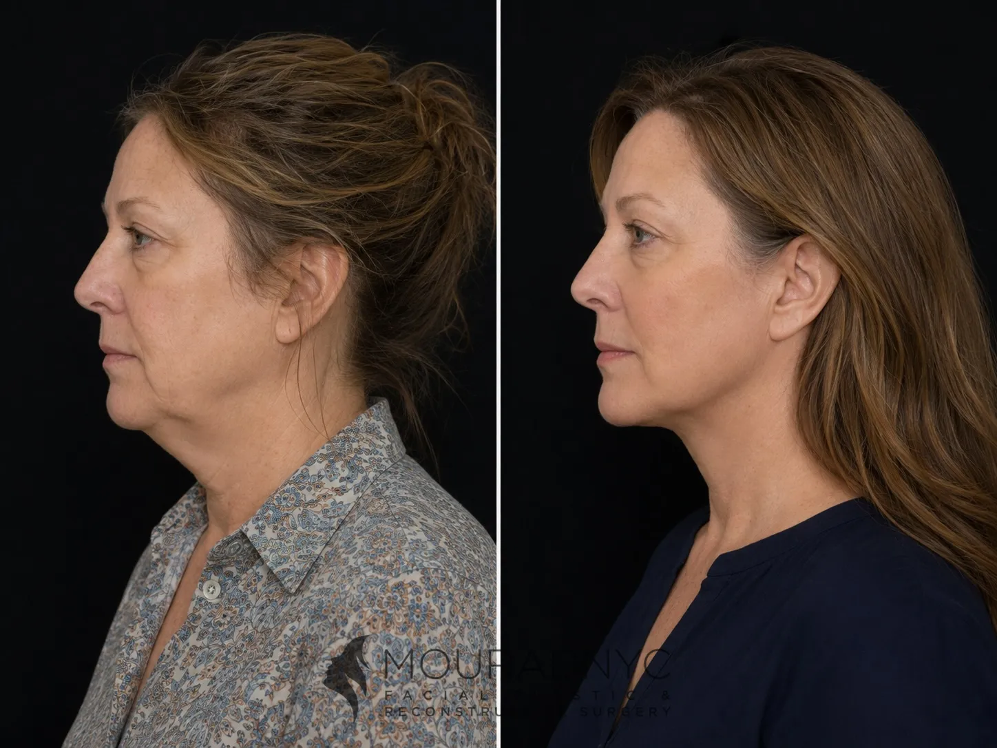 Left lateral profile comparison of a female patient in her 50s before and after facelift with neck lift
