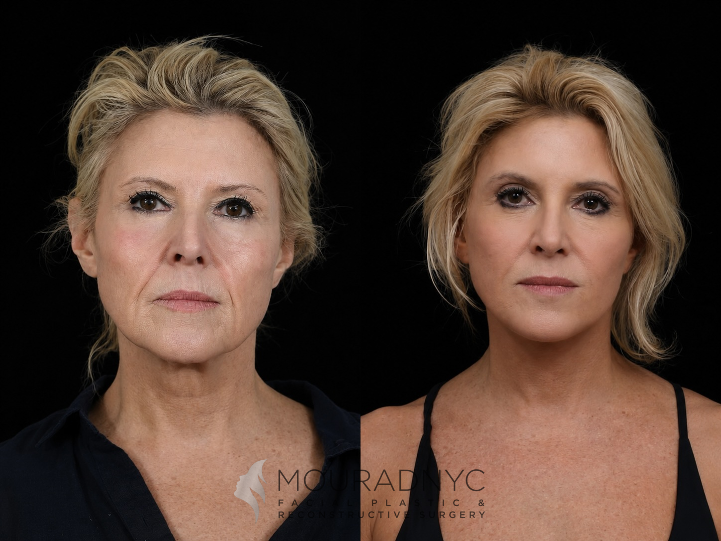 Frontal comparison of a female patient in her 50s before and after facelift with neck lift and rhinoplasty