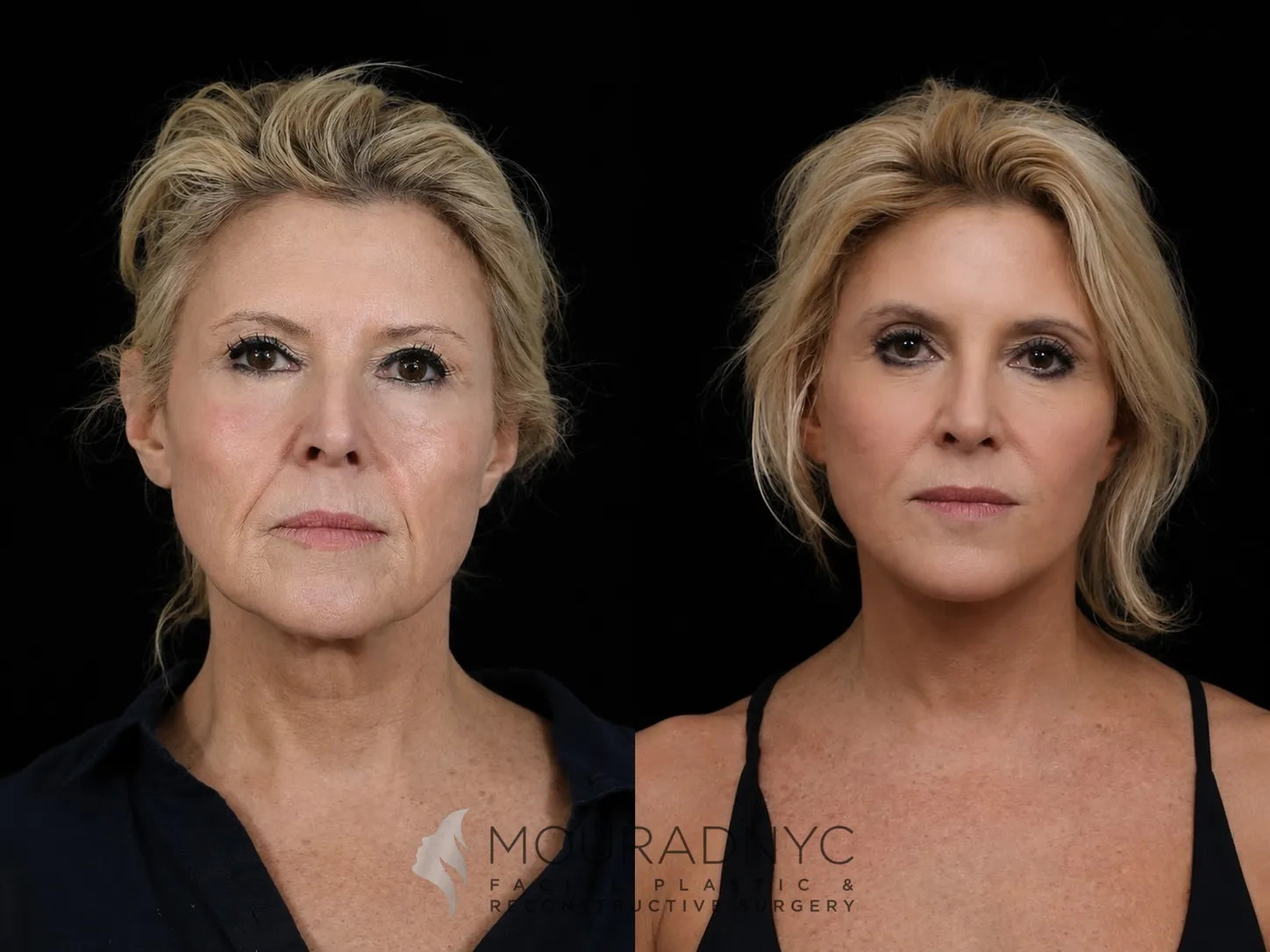 Frontal comparison of a female patient in her 50s before and after facelift with neck lift and rhinoplasty