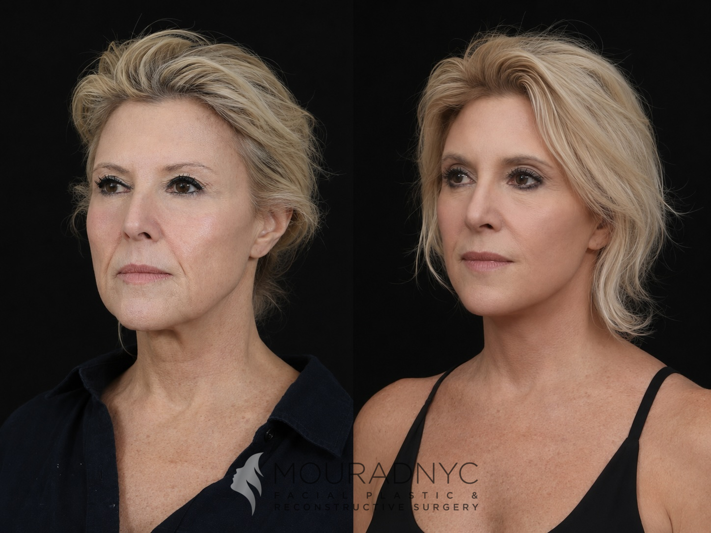Left oblique comparison of a female patient in her 50s before and after facelift with neck lift and rhinoplasty