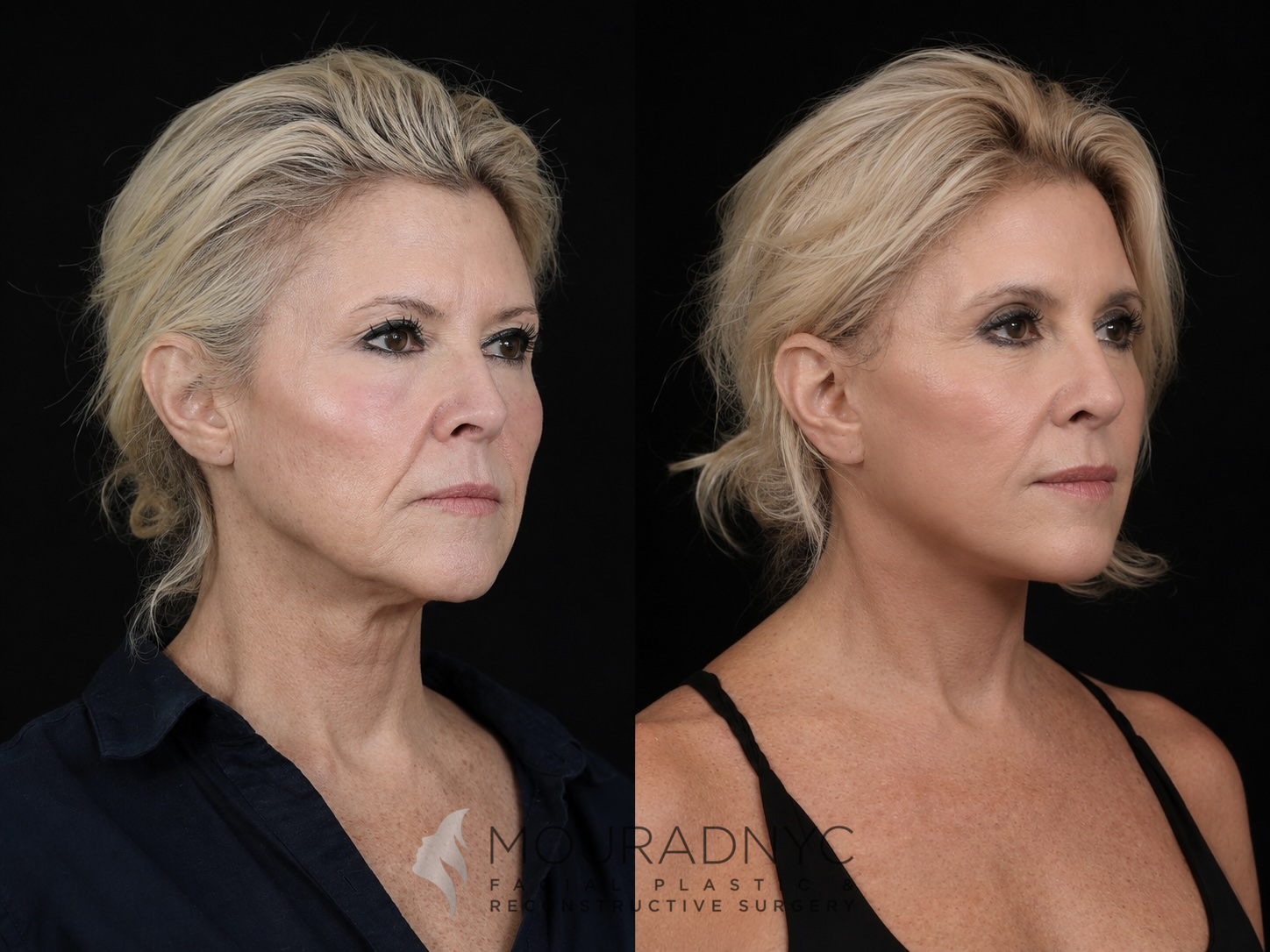 Right oblique comparison of a female patient in her 50s before and after facelift with neck lift and rhinoplasty