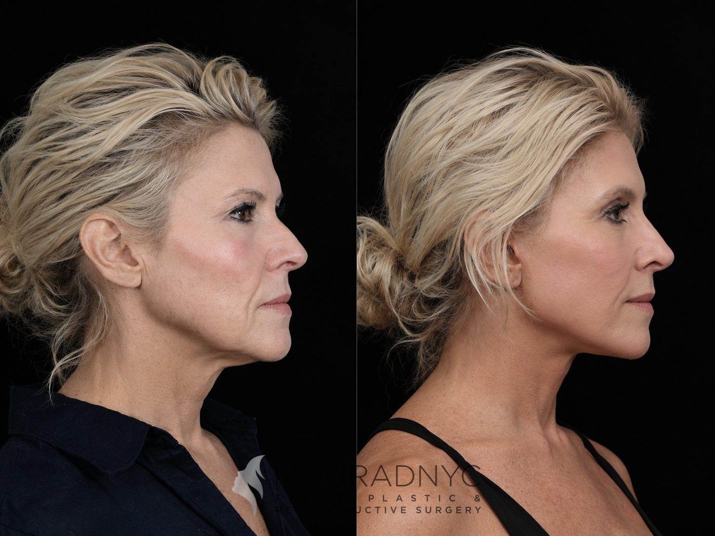 Right lateral profile comparison of a female patient in her 50s before and after facelift with neck lift and rhinoplasty