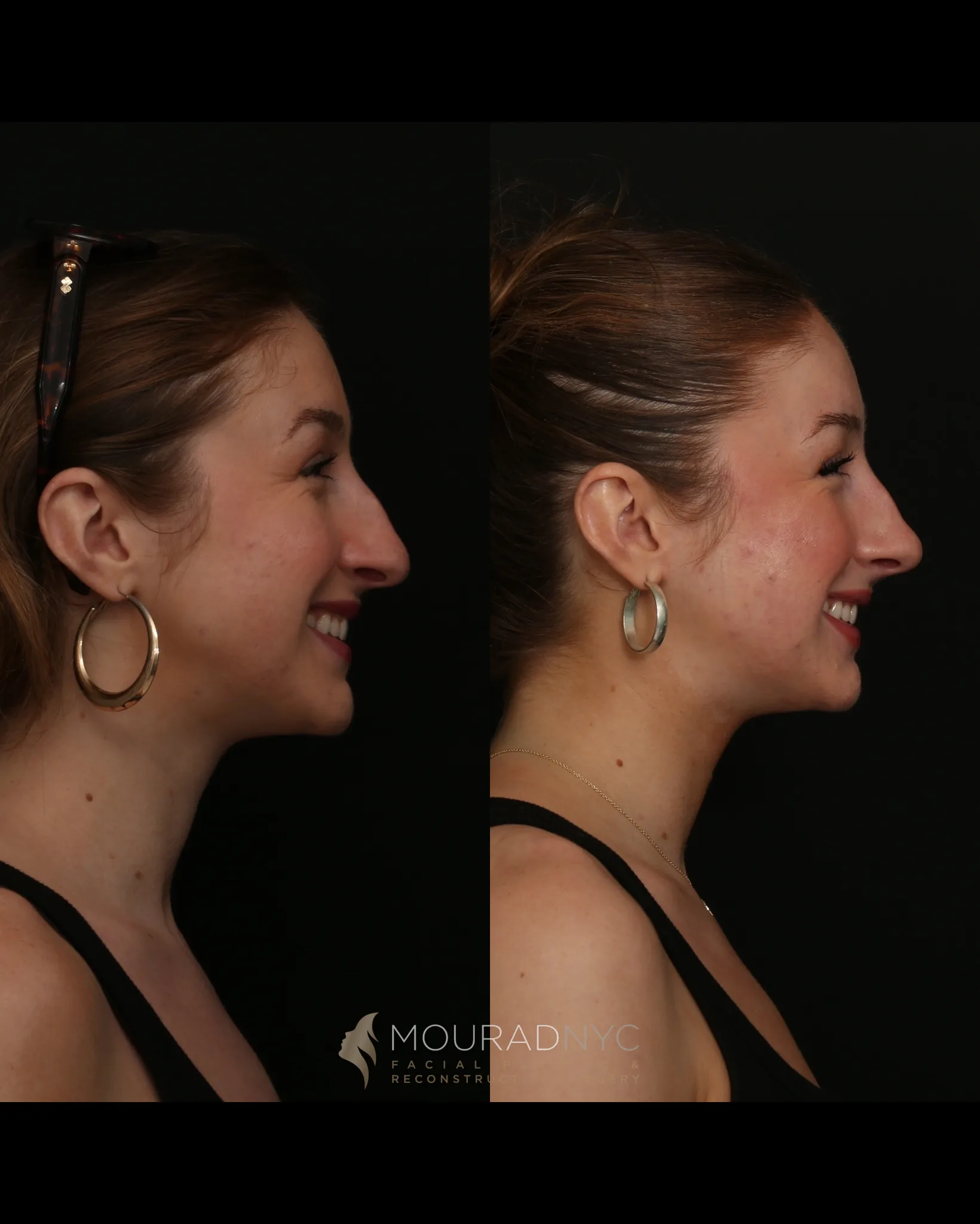 Smiling right lateral profile comparison before and after Nasalift nasal tip elevation