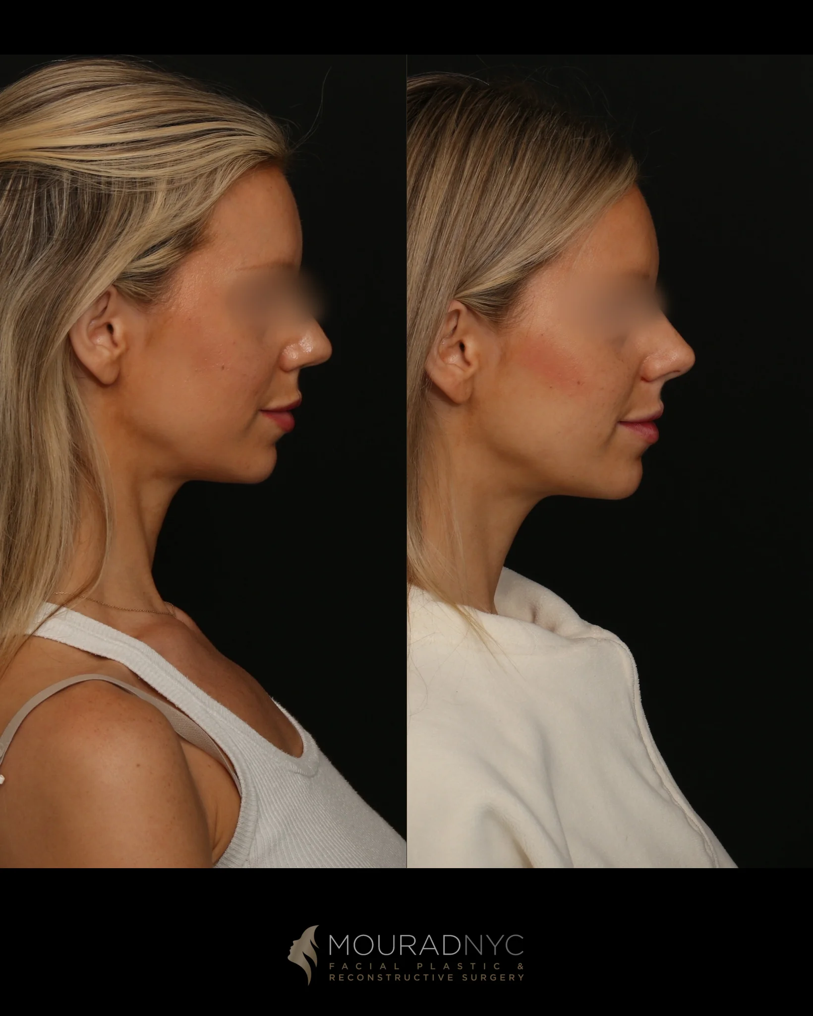 Nasalift before-and-after right lateral profile at rest, with eyes blurred; before on the left, after on the right