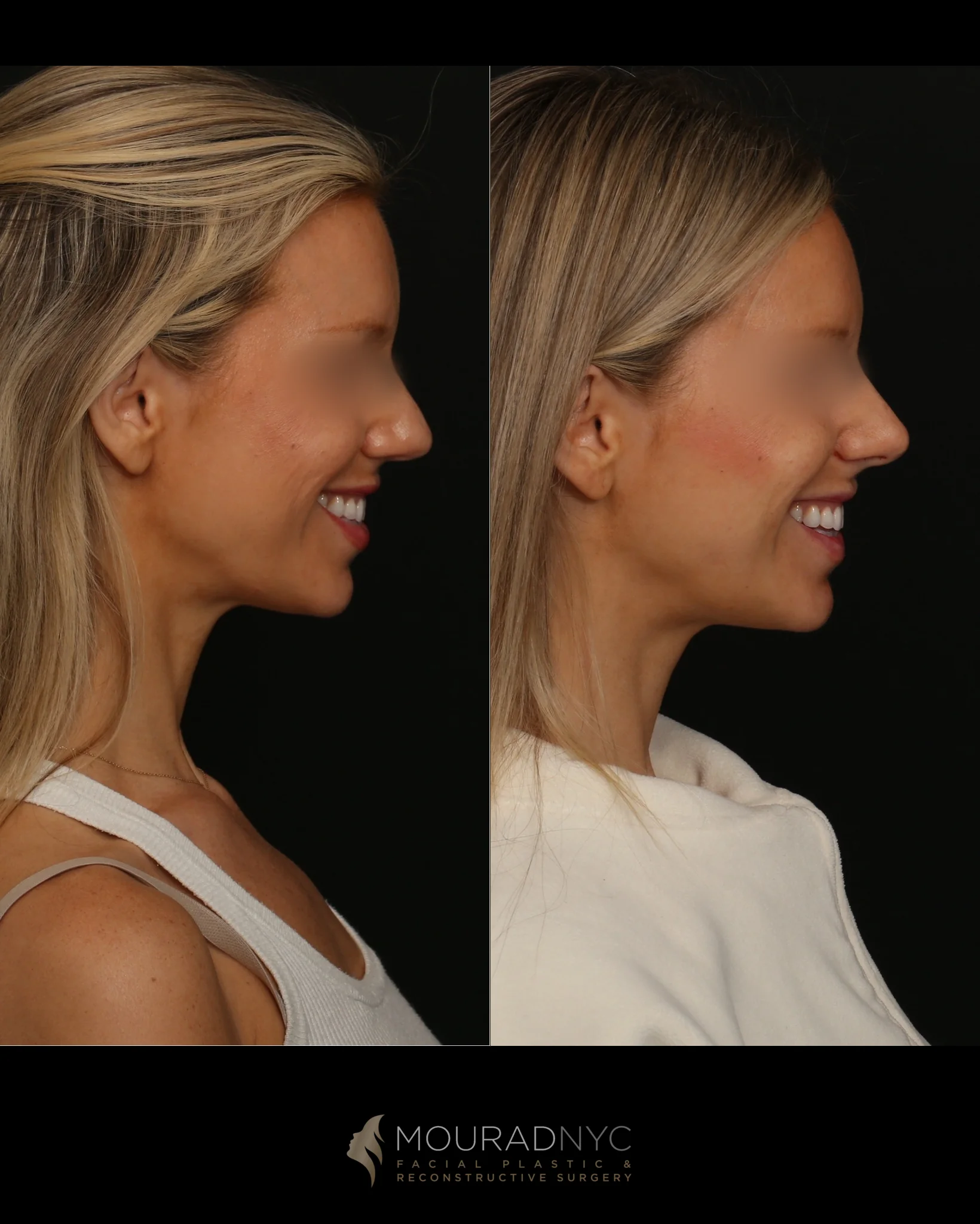 Nasalift before-and-after smiling right lateral profile, with eyes blurred; before on the left, after on the right