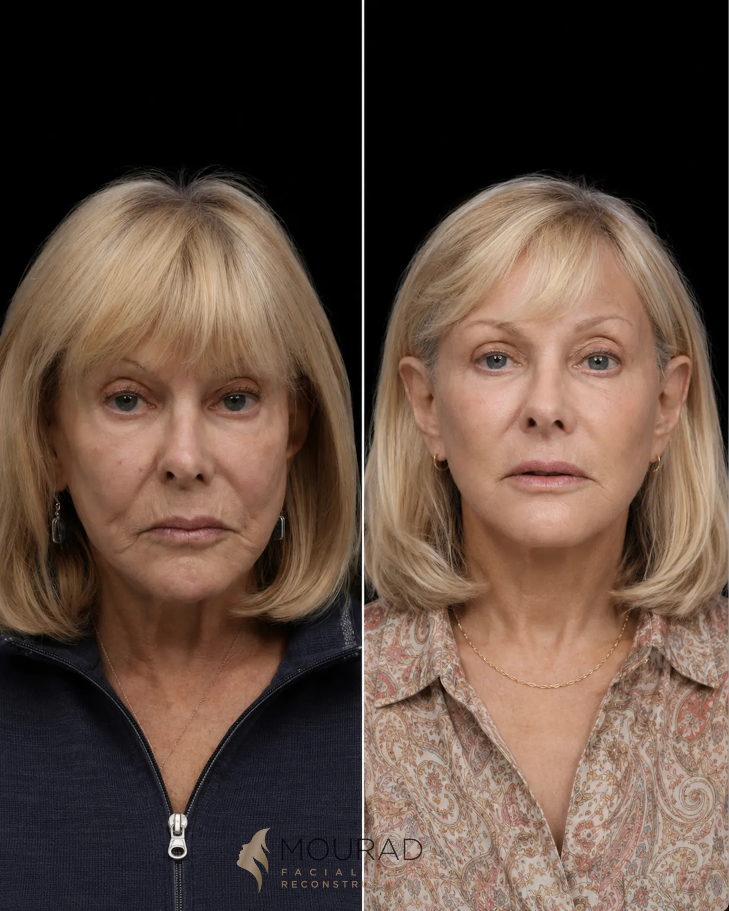Frontal comparison of a female patient in her 70s before and after revision facelift with neck lift