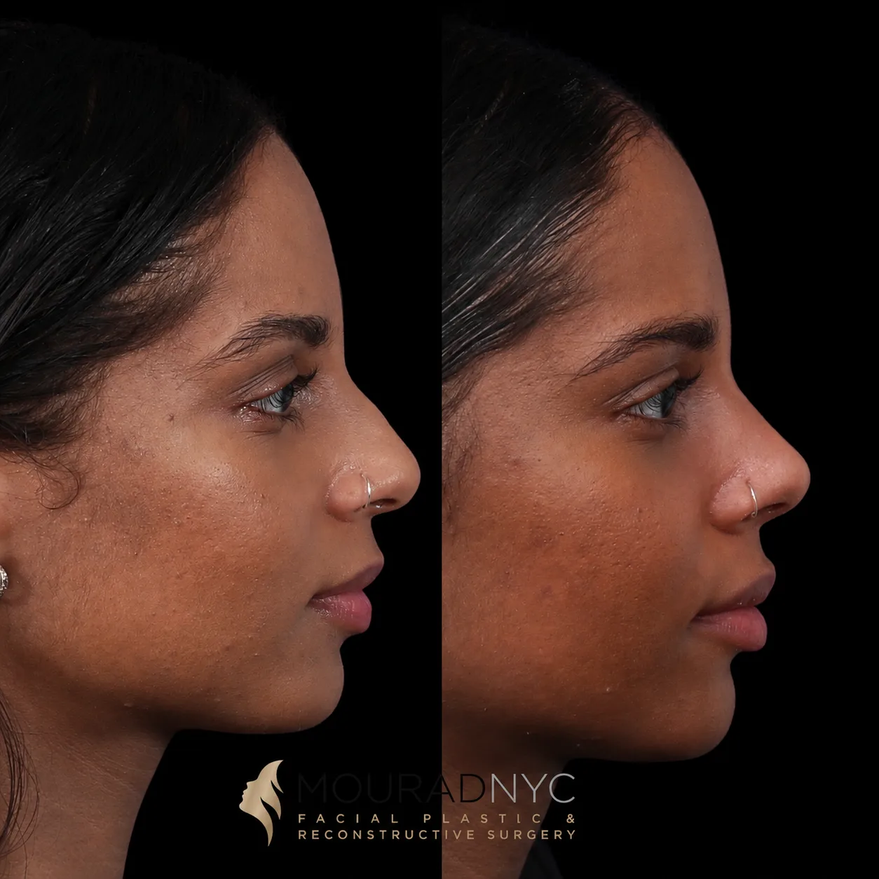 Right lateral profile comparison of a female patient in her 20s before and after primary rhinoplasty