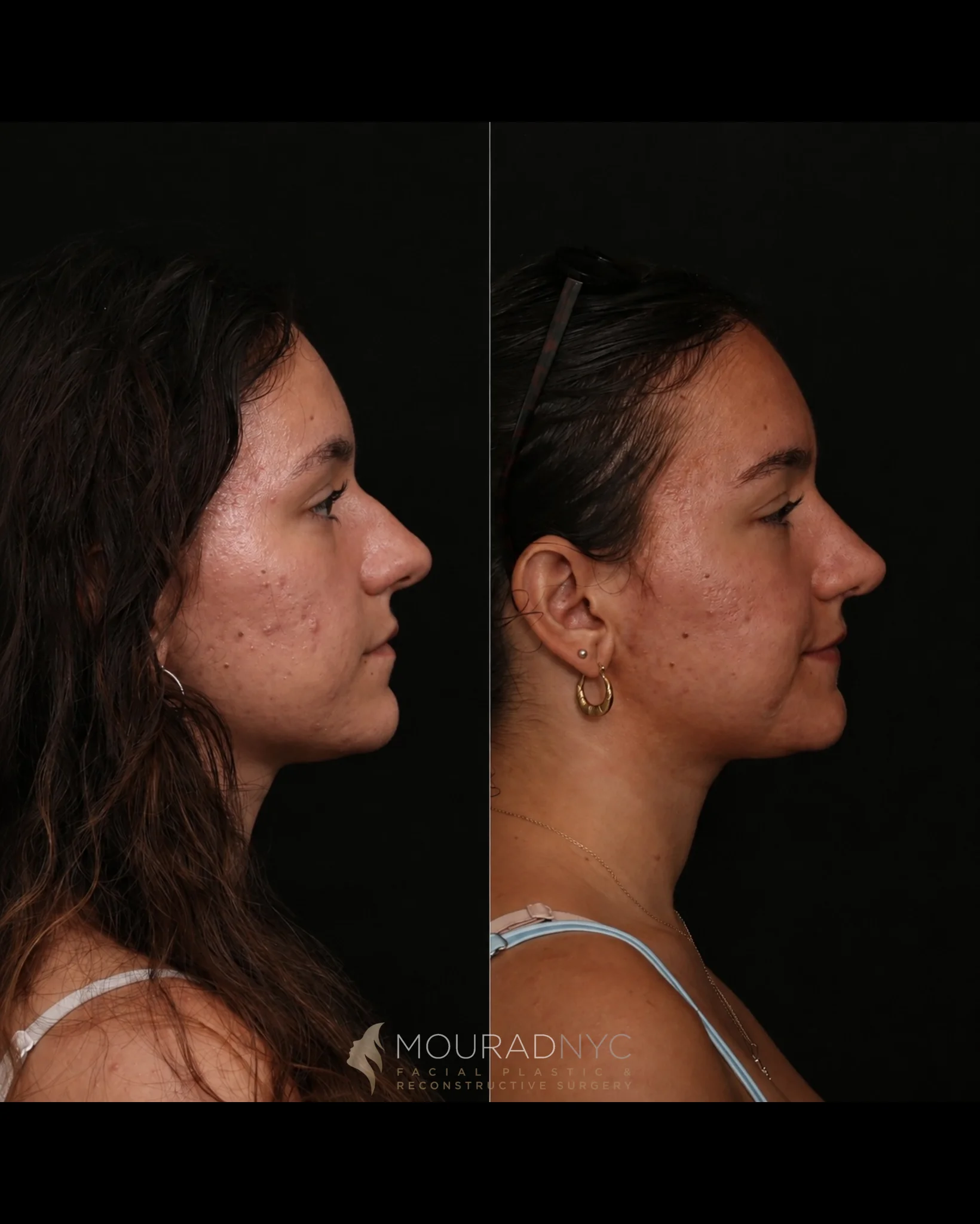 Right lateral profile comparison of a female patient in her 20s before and after preservation rhinoplasty