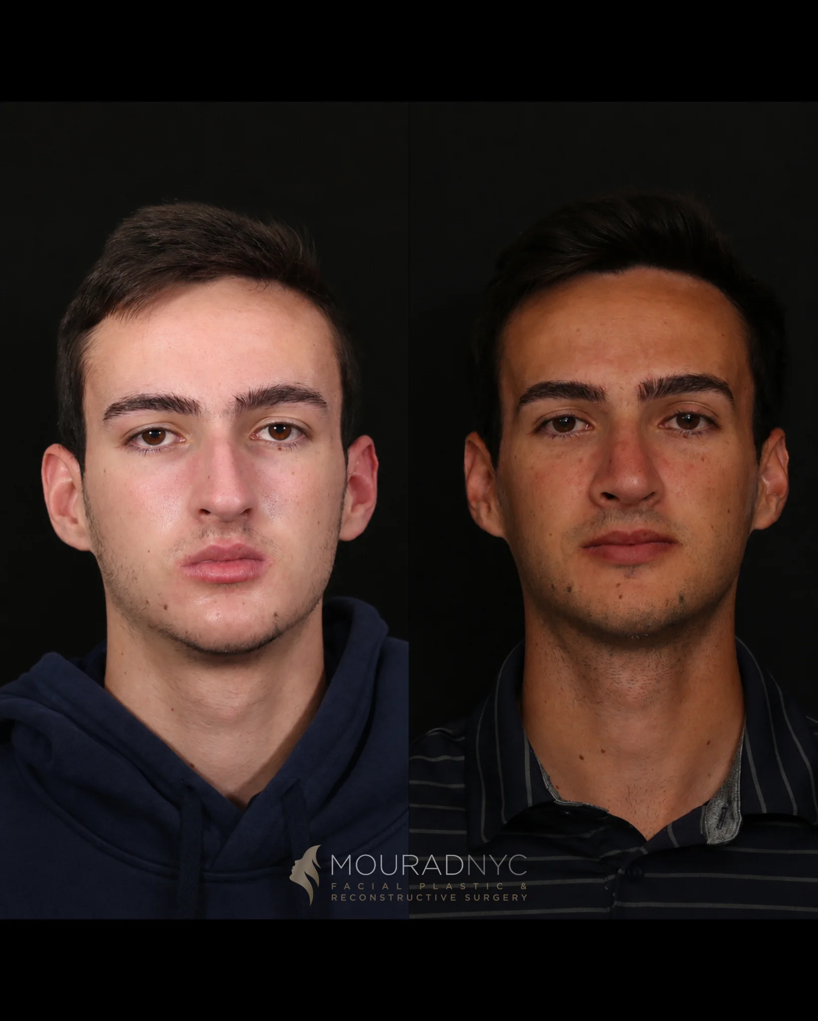 Frontal comparison of a male patient before primary rhinoplasty at age 17 and five years after surgery