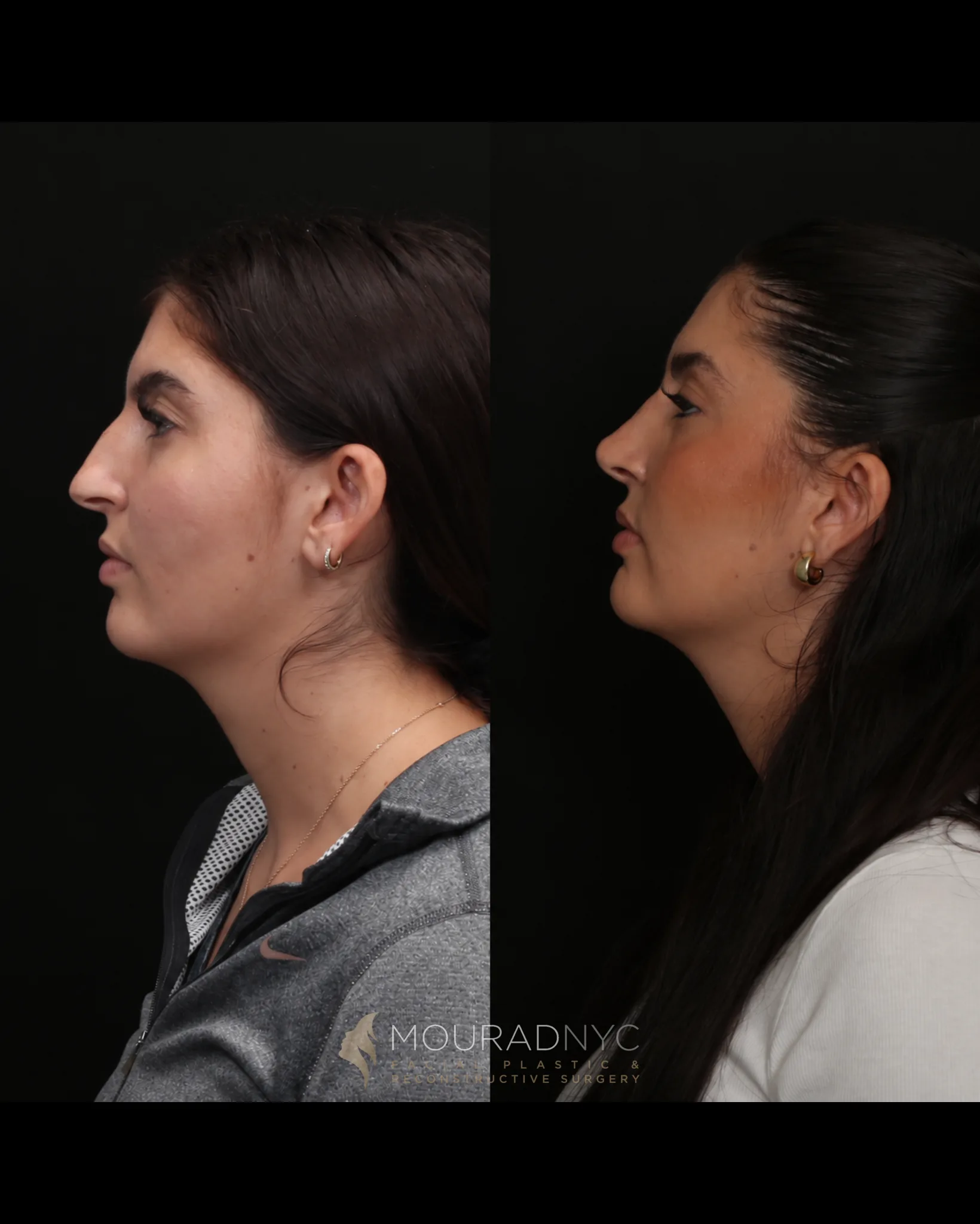 Left lateral profile comparison of a female patient in her 20s before rhinoplasty and three years after surgery