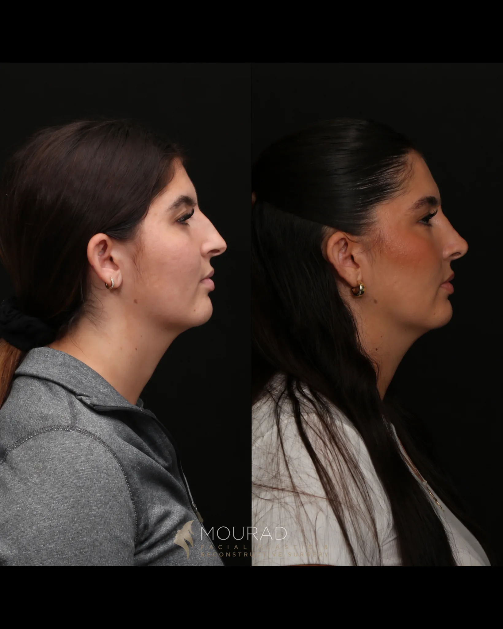 Right lateral profile comparison of a female patient in her 20s before rhinoplasty and three years after surgery