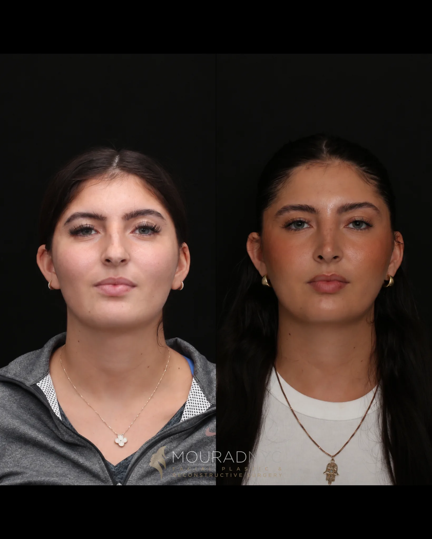 Frontal comparison of a female patient in her 20s before rhinoplasty and three years after surgery