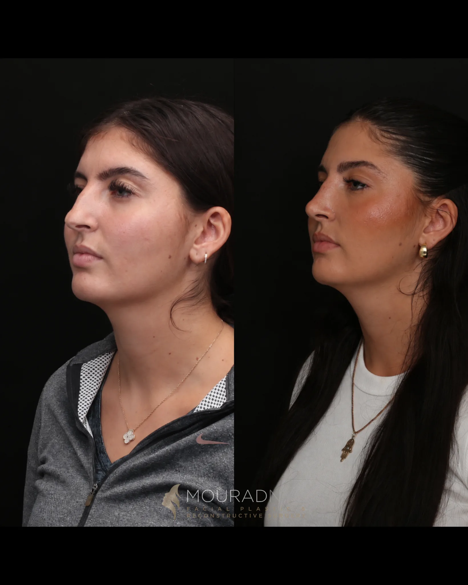 Left three-quarter comparison of a female patient in her 20s before rhinoplasty and three years after surgery