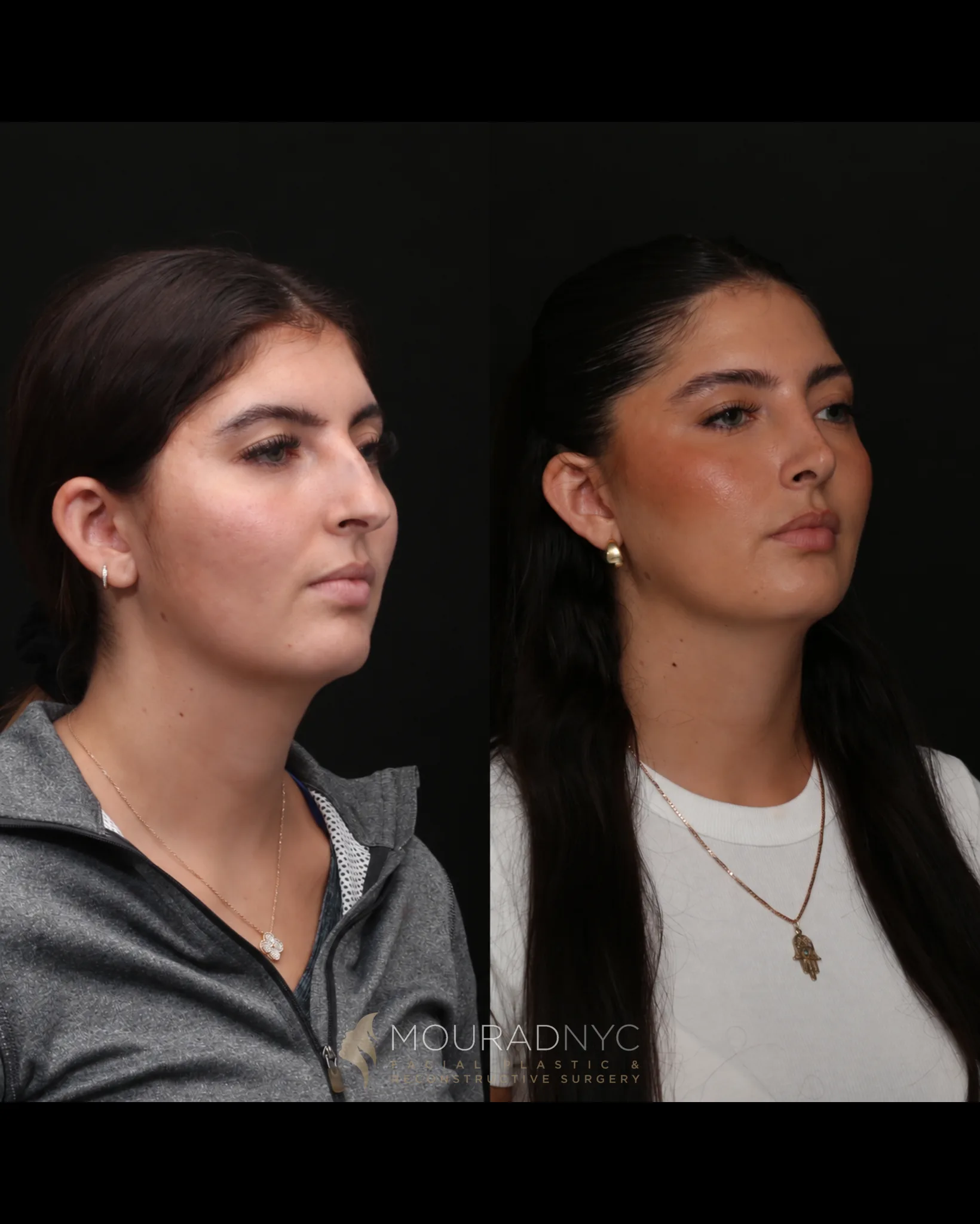 Right three-quarter comparison of a female patient in her 20s before rhinoplasty and three years after surgery