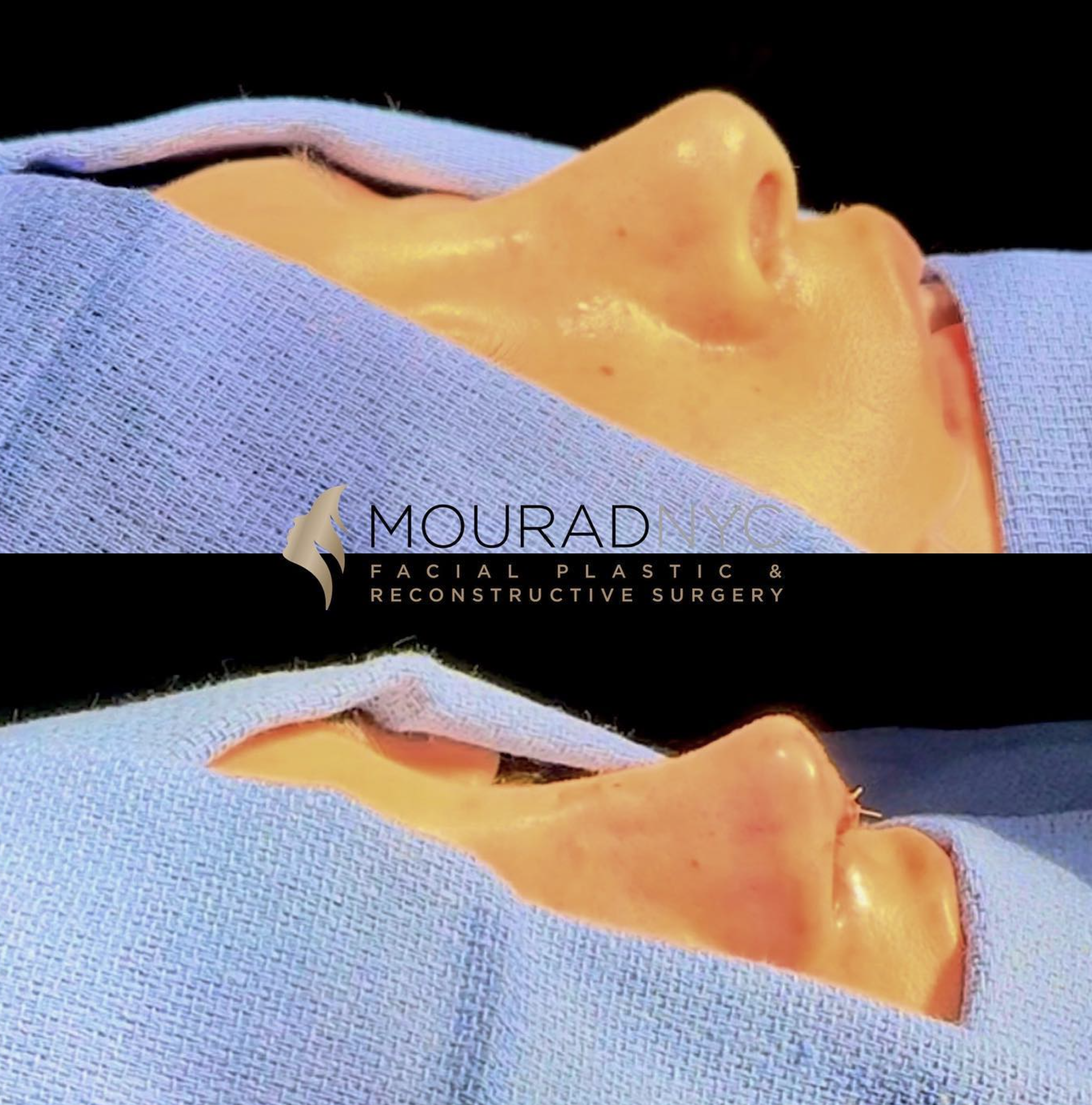 Intra-operative basal view of the nasal base and tip during primary rhinoplasty on a female patient in her 20s