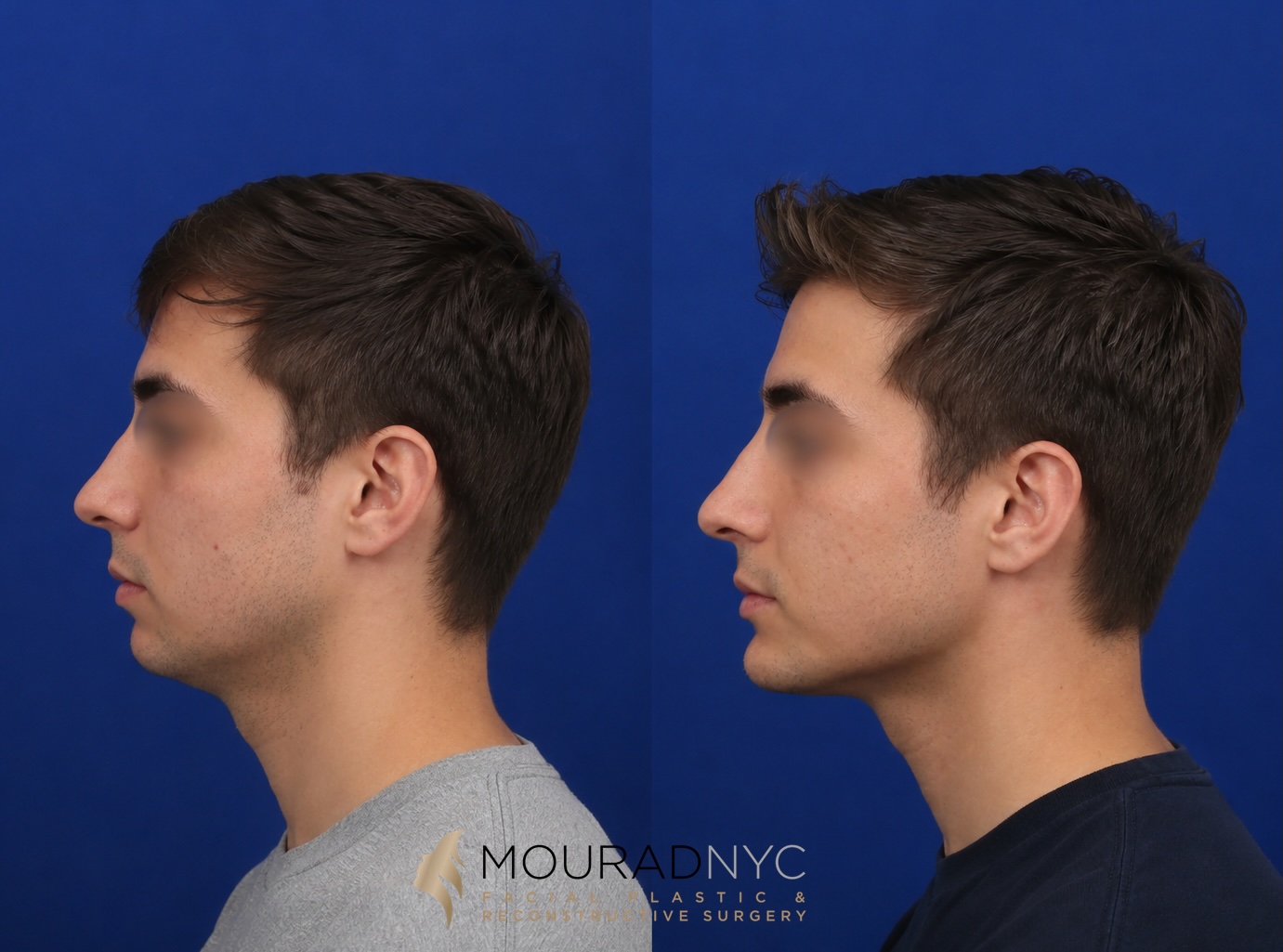 Left lateral profile comparison of a male patient in his 20s before and after sliding genioplasty