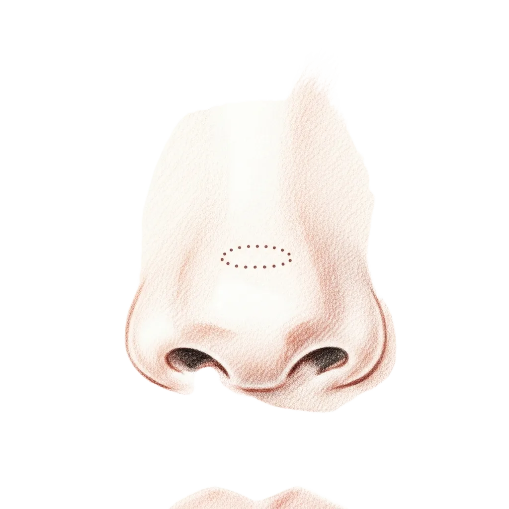 Pencil-sketch illustration of nasal polyps within the middle meatus and their endoscopic removal.