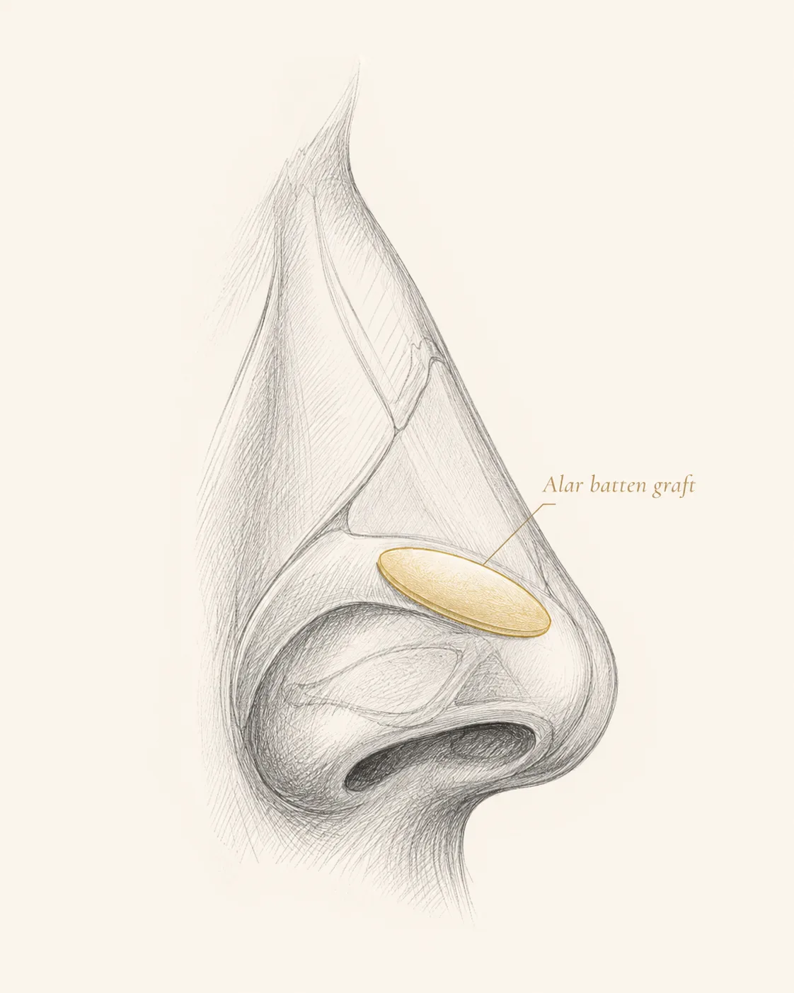 Pencil-style lateral illustration of the nose showing a broad alar batten graft bracing the lateral sidewall above the nostril rim.