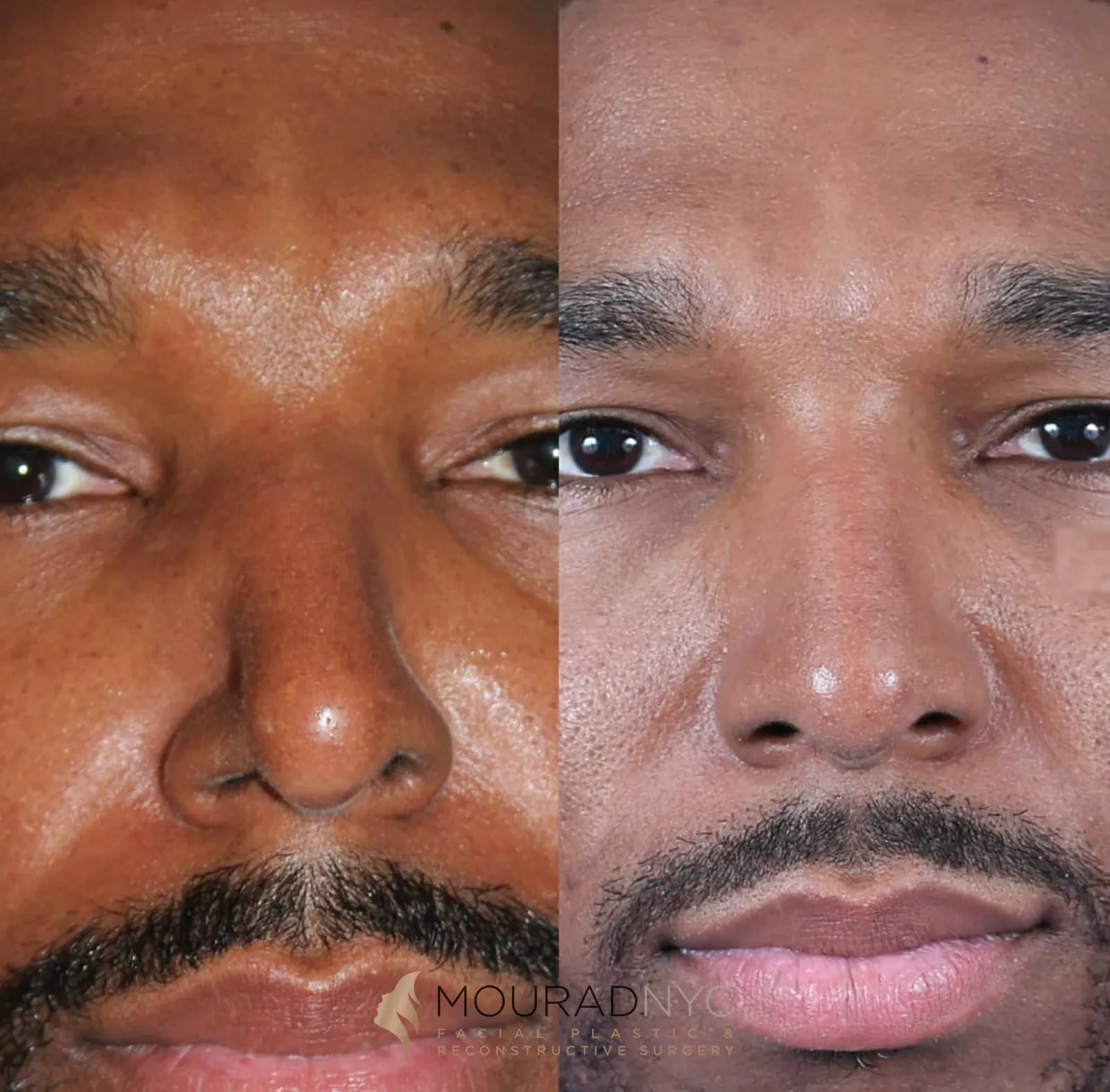 Frontal before-and-after comparison of a male patient following nasal valve collapse treatment