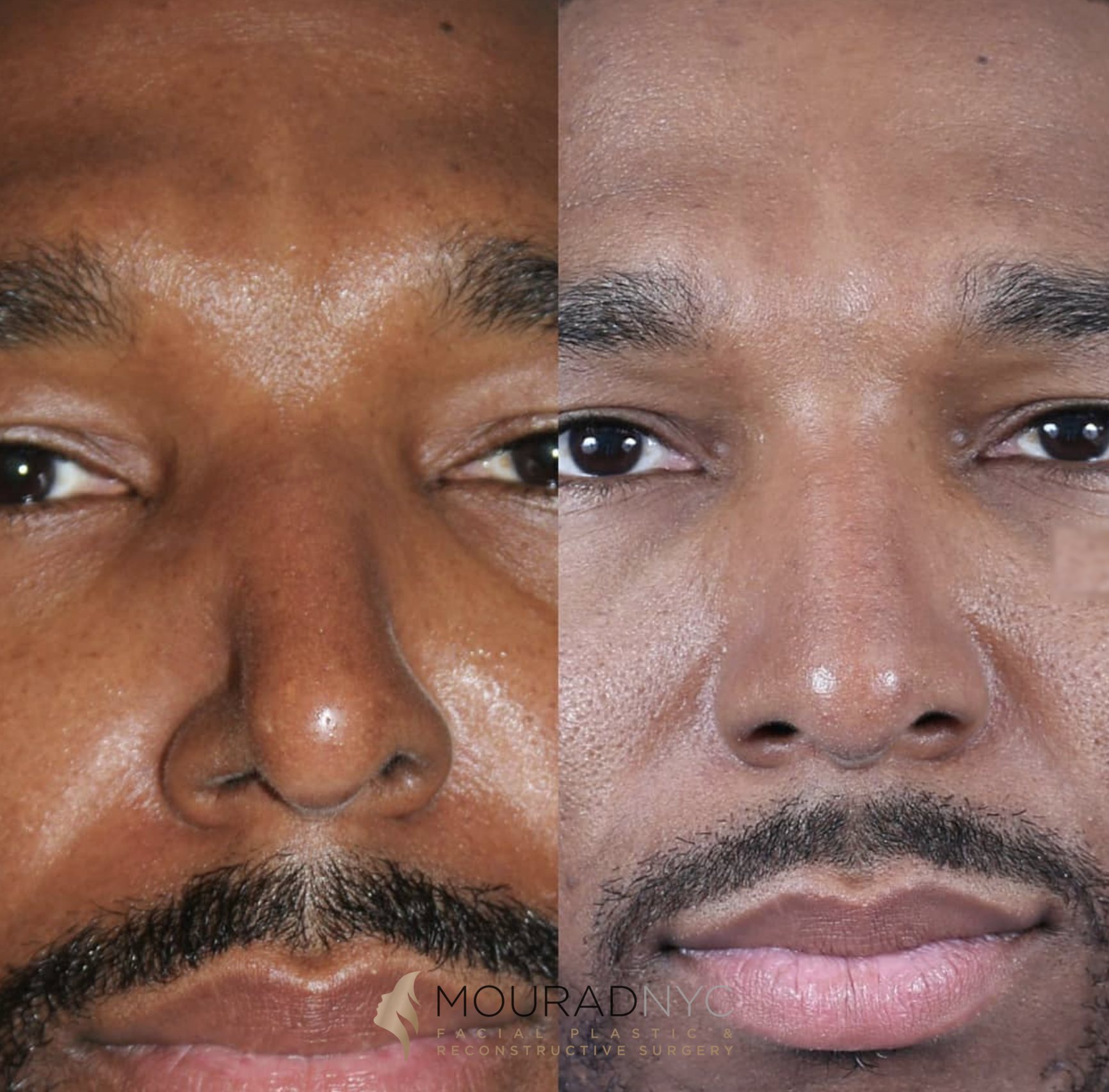 Frontal before-and-after comparison of a male patient following nasal valve collapse treatment