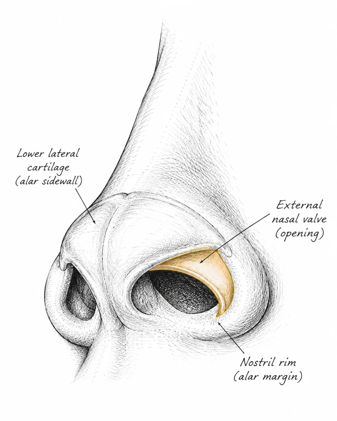 Pencil-sketch three-quarter view of the nose highlighting the external nasal valve at the nostril opening, the site examined for visible rim collapse on inhalation.