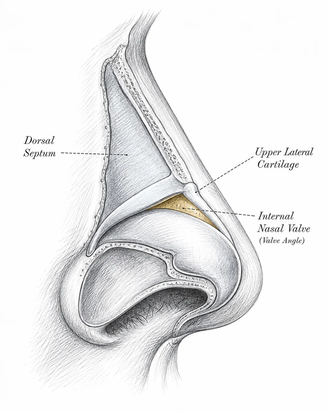 Pencil-sketch cross-section of the nose highlighting the internal nasal valve angle between the dorsal septum and upper lateral cartilage, the site examined for high sidewall collapse.