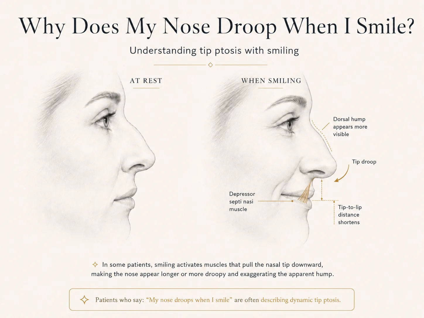 Side-by-side educational illustration showing the nose at rest and drooping when smiling, with depressor septi nasi muscle pull, increased apparent dorsal hump visibility, and a shorter tip-to-upper-lip distance.