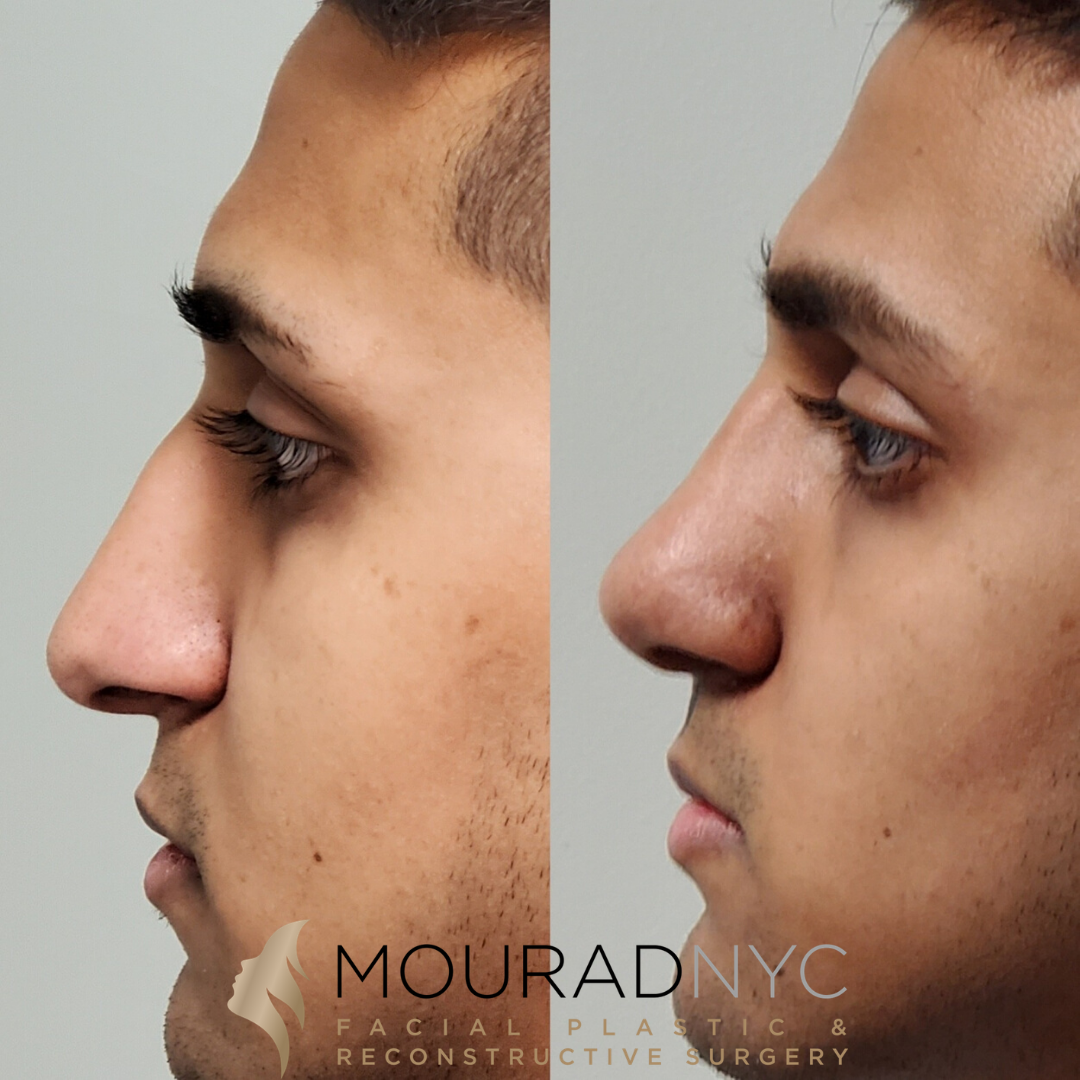 Прямой нос с горбинкой у мужчин. Rhinoplasty before and after. Male Rhinoplasty.