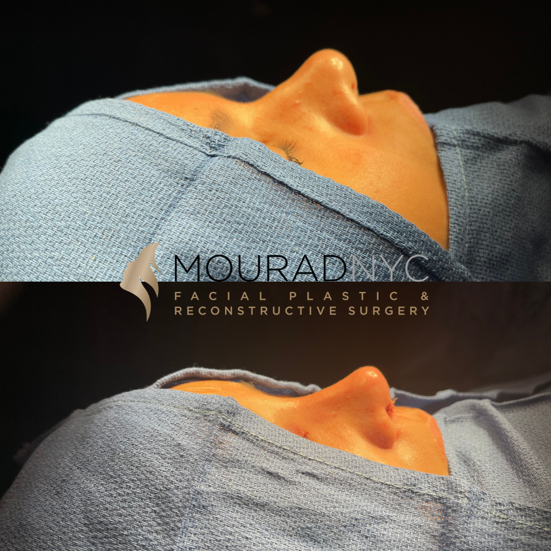 1 Rhinoplasty & Female Rhinoplasty
