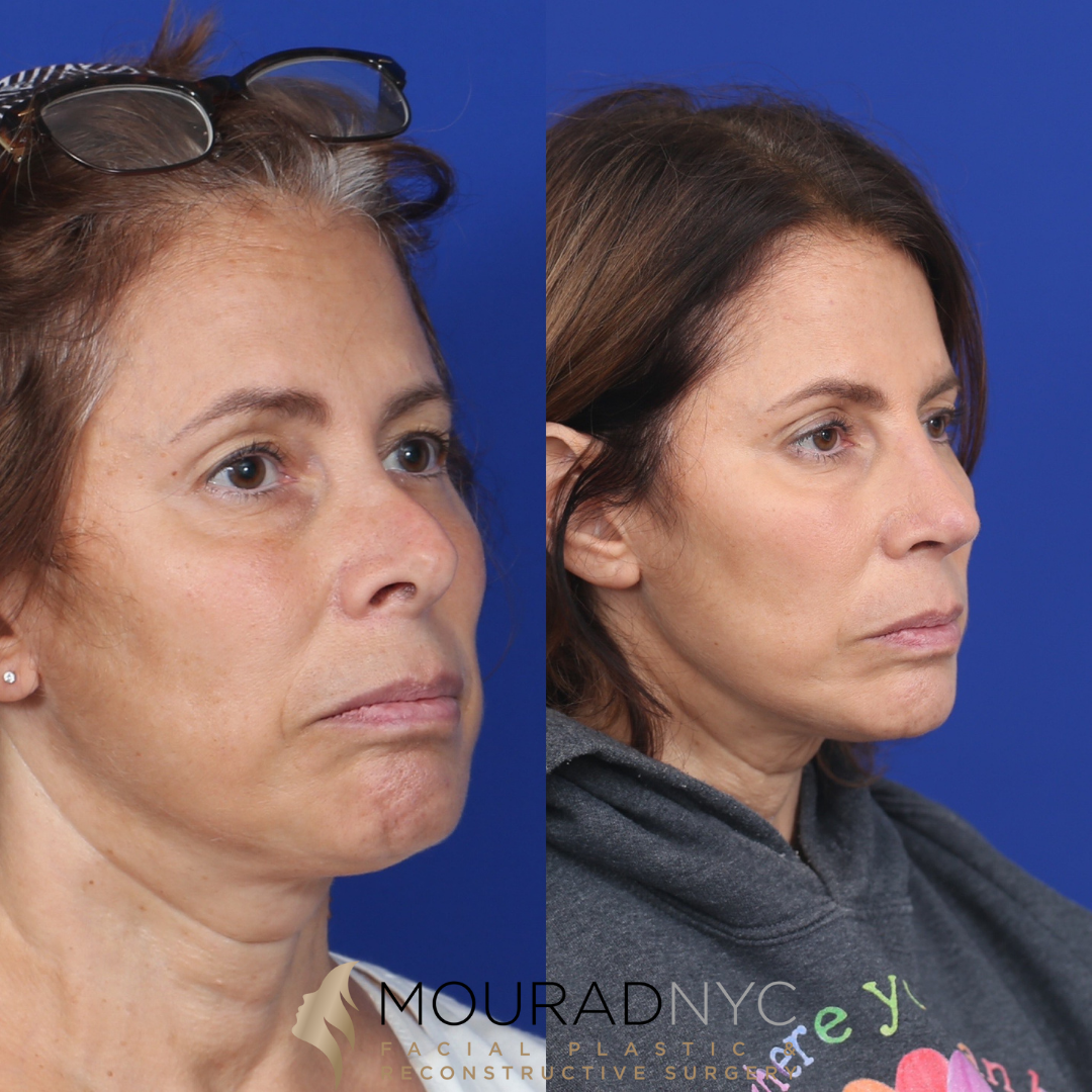 2 Rhinoplasty & Female Rhinoplasty
