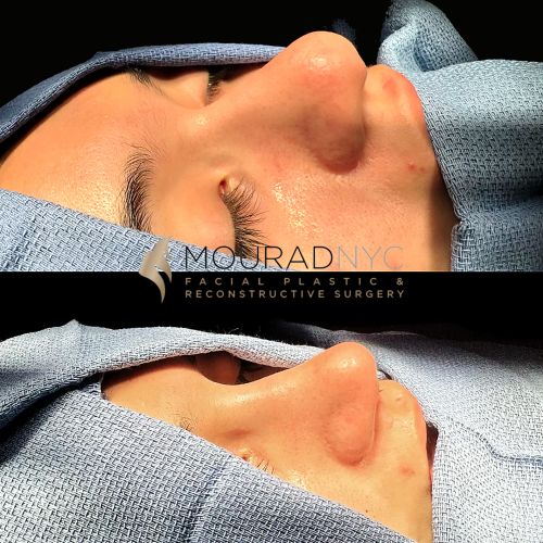 Before and After Rhinoplasty